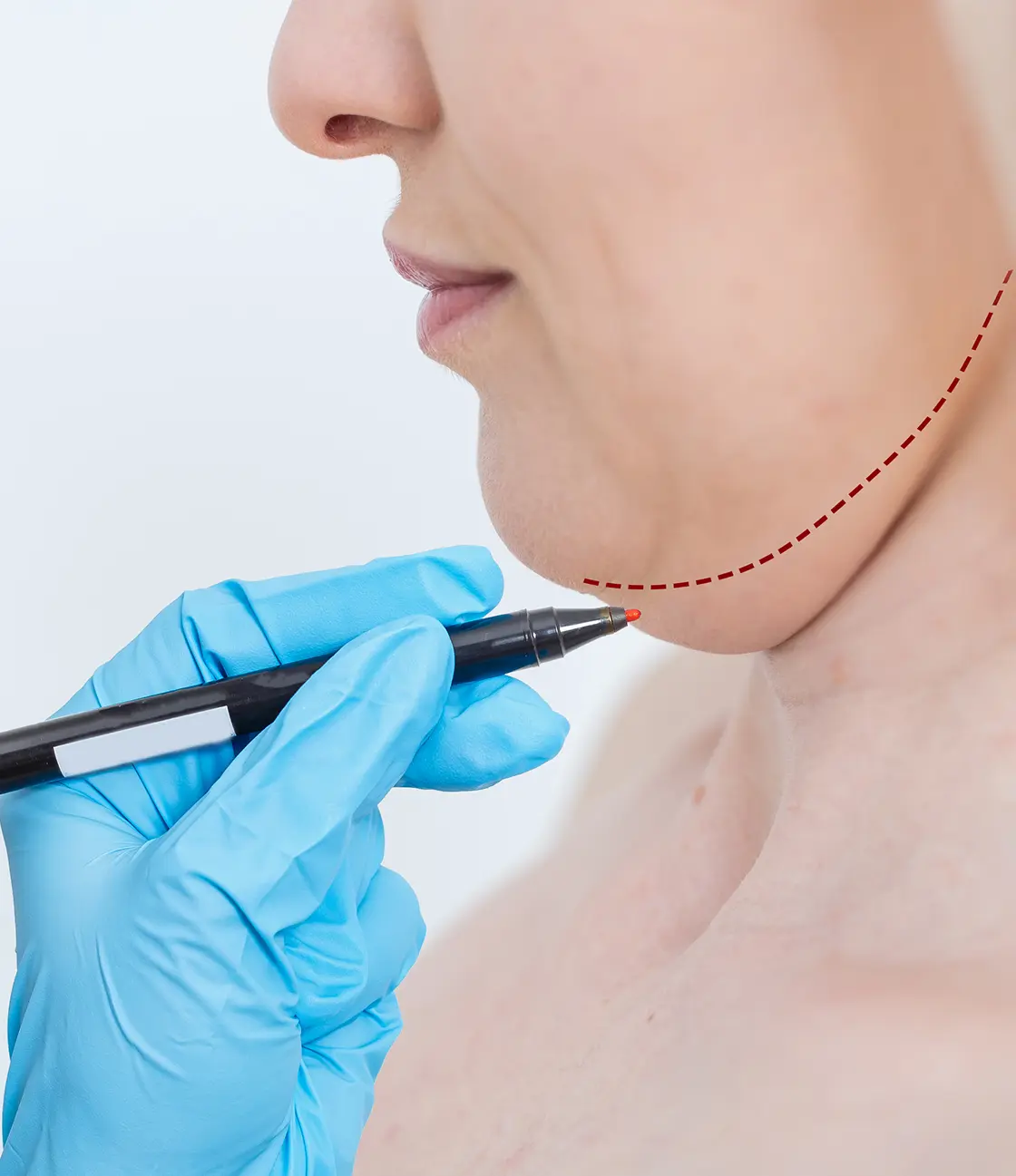 Liposucción de Papada en Madrid