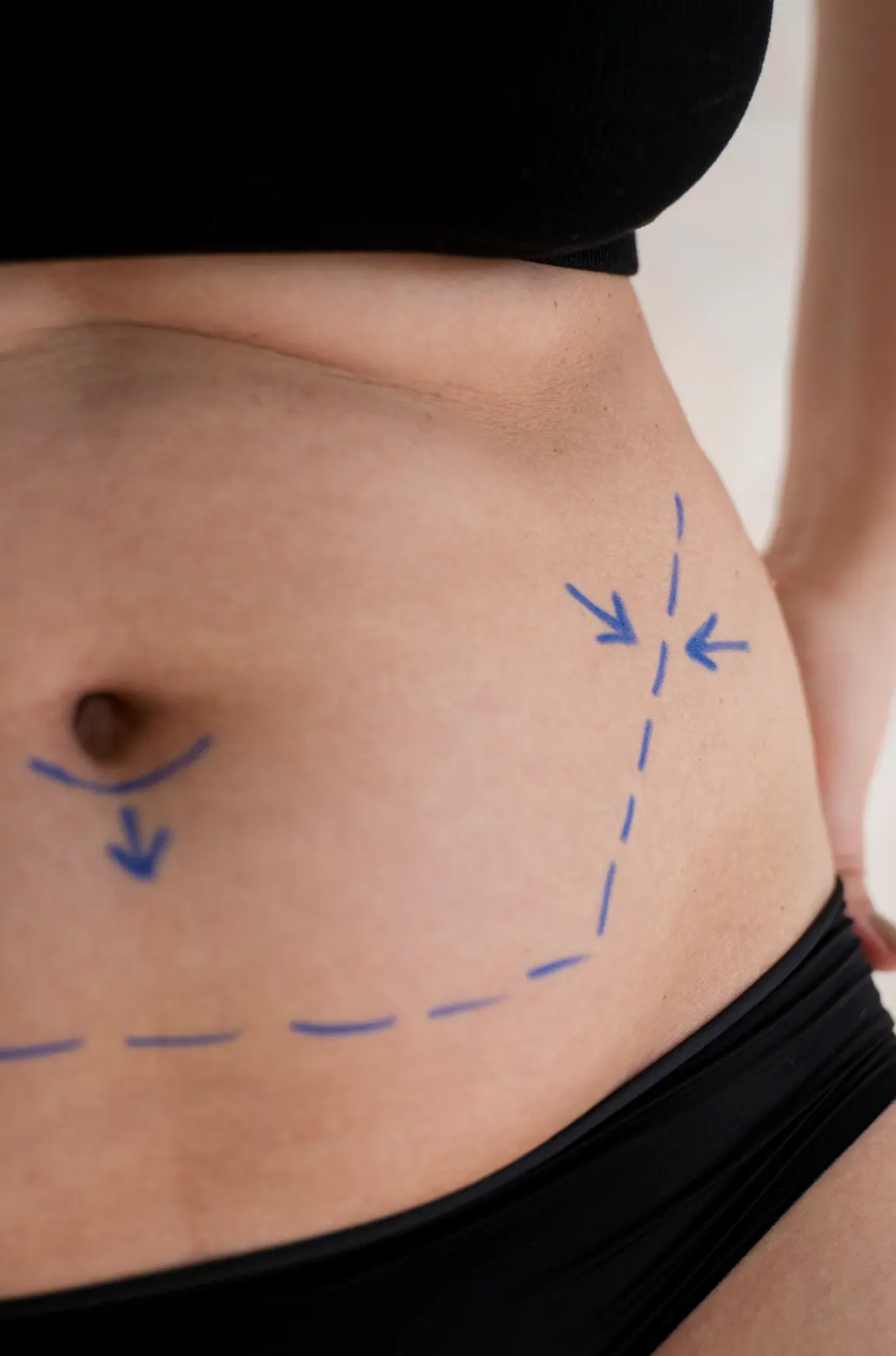 lipoescultura alta definición