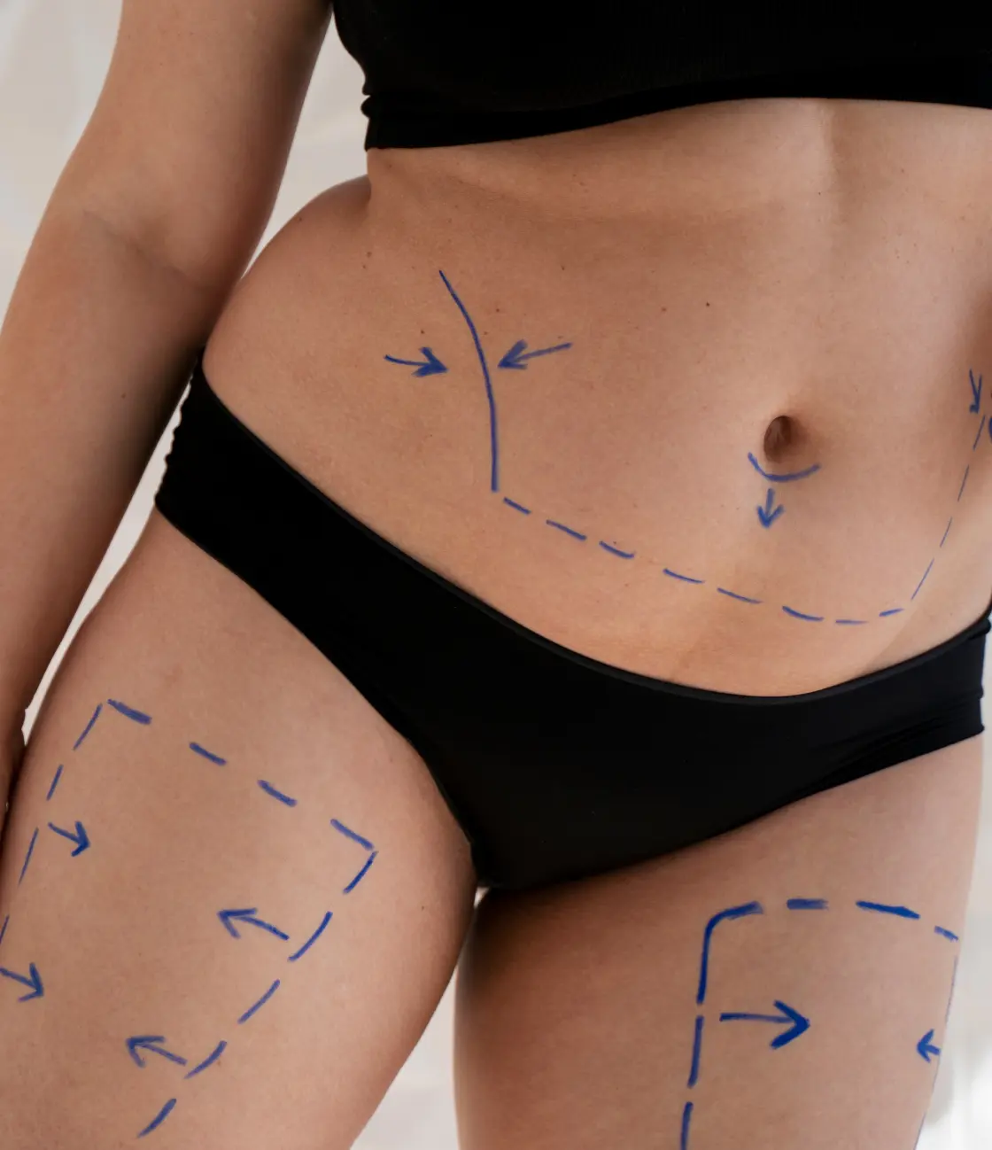 liposucción de grasa Madrid