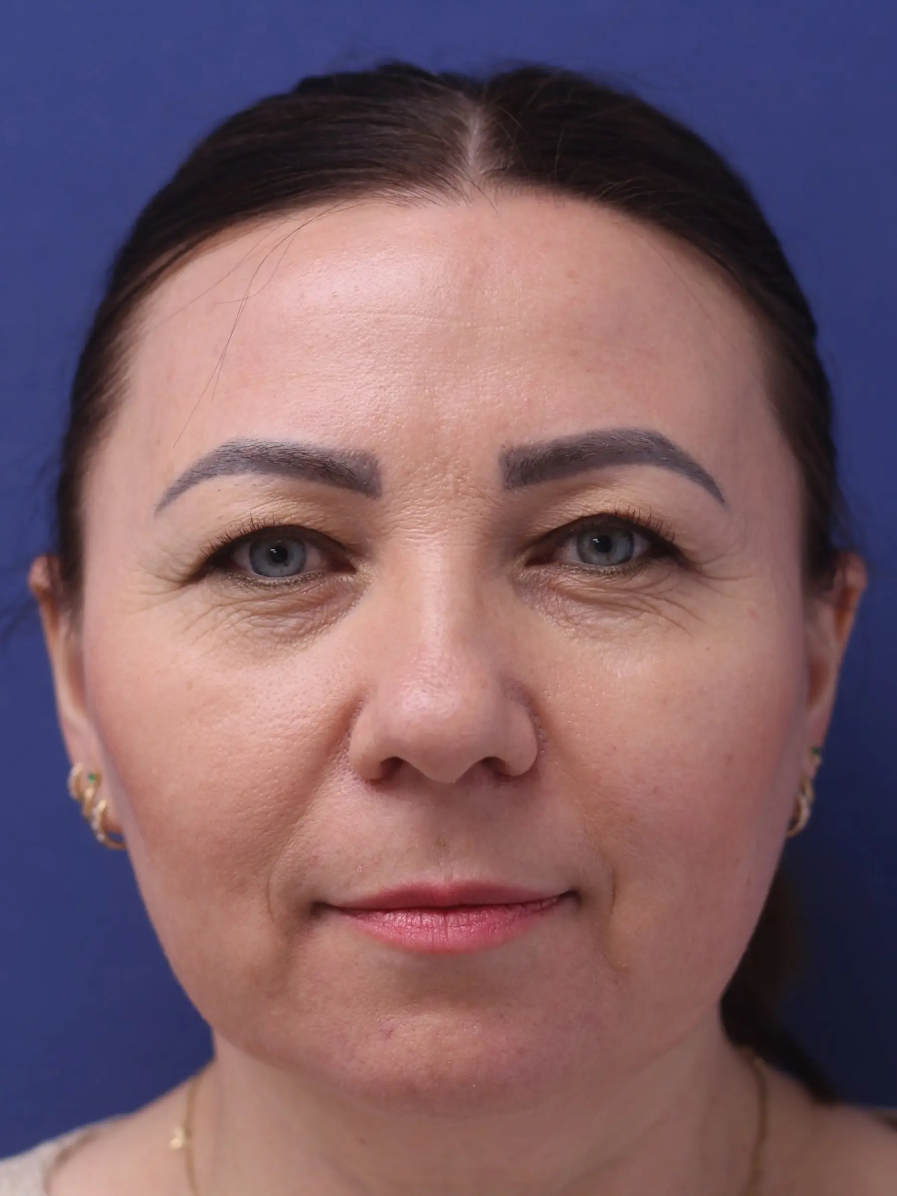 Paciente-Blefaroplastia-01