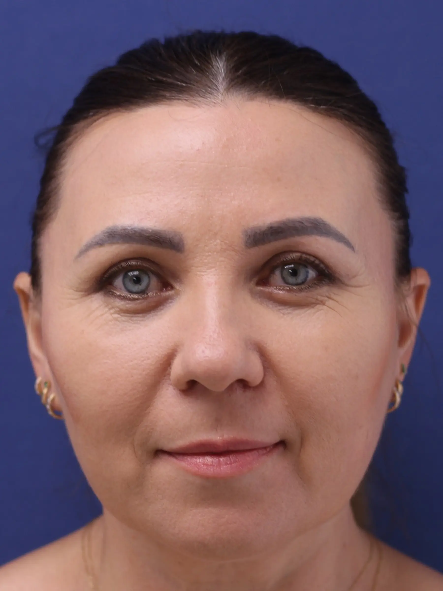 Paciente-Blefaroplastia-02