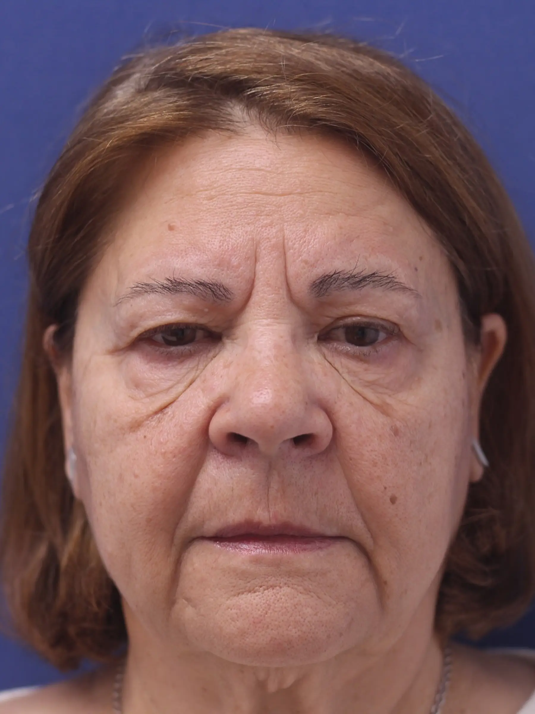 Paciente-Blefaroplastia-03