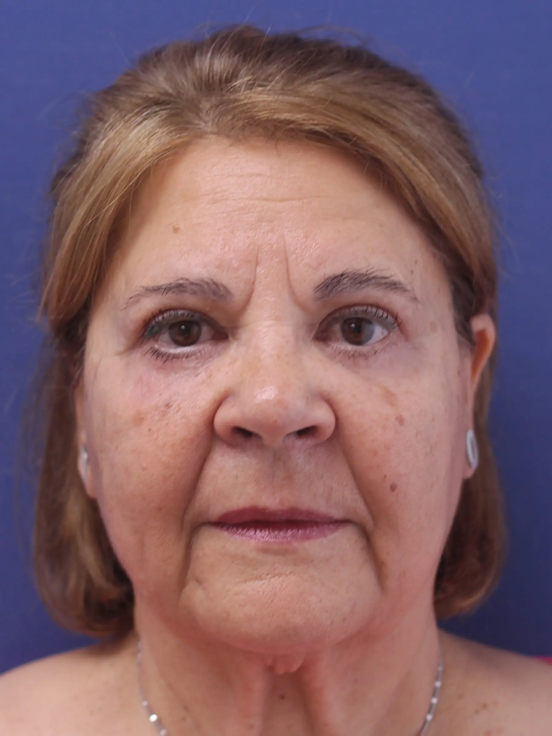 Paciente-Blefaroplastia-04