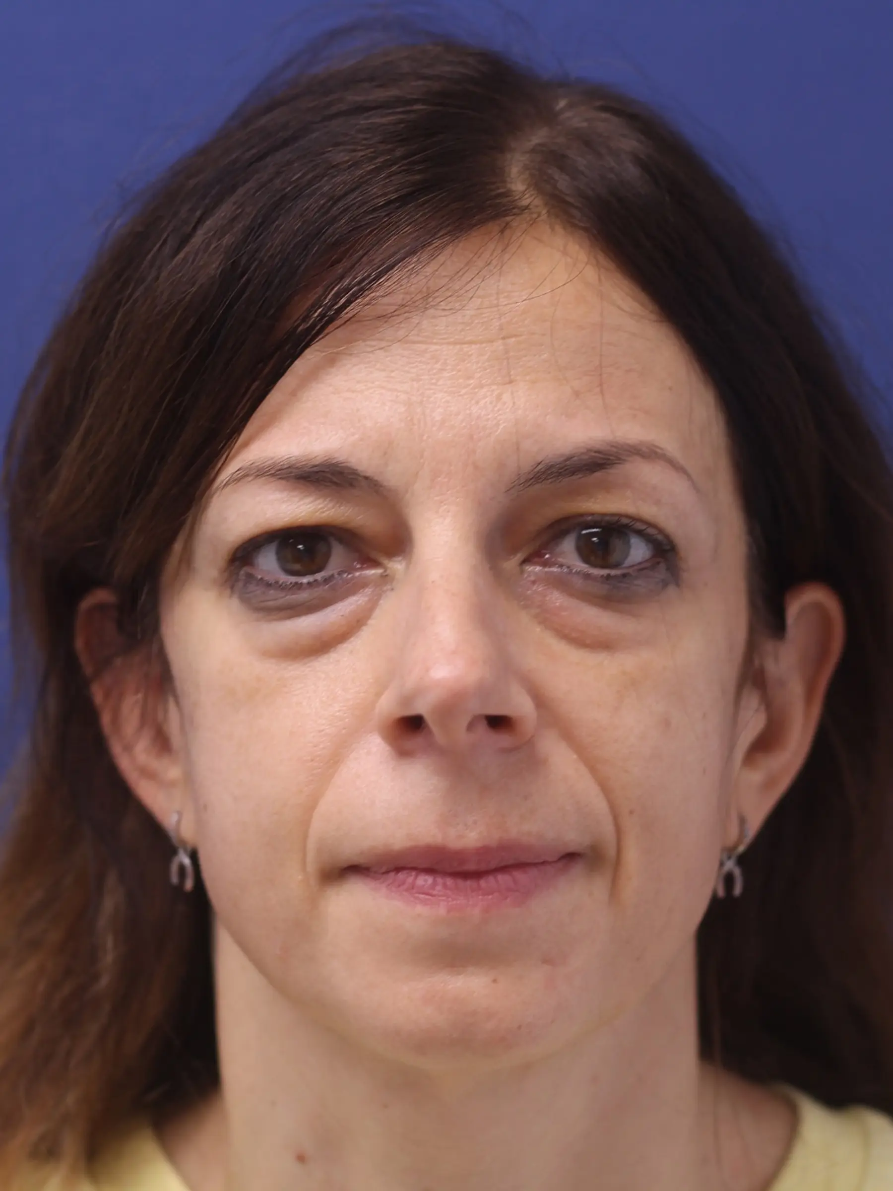 Paciente-Blefaroplastia-05