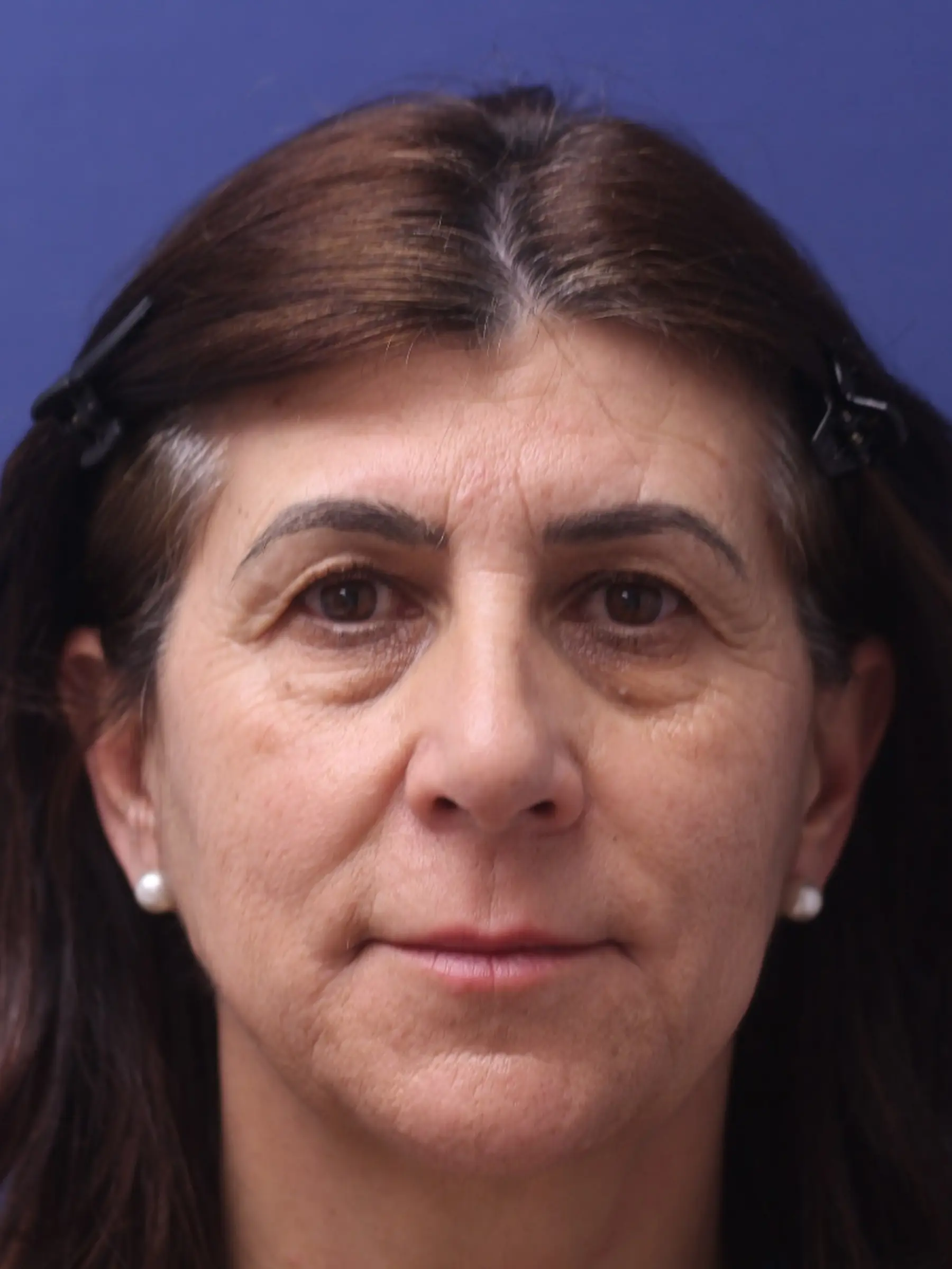 Paciente-Blefaroplastia-07