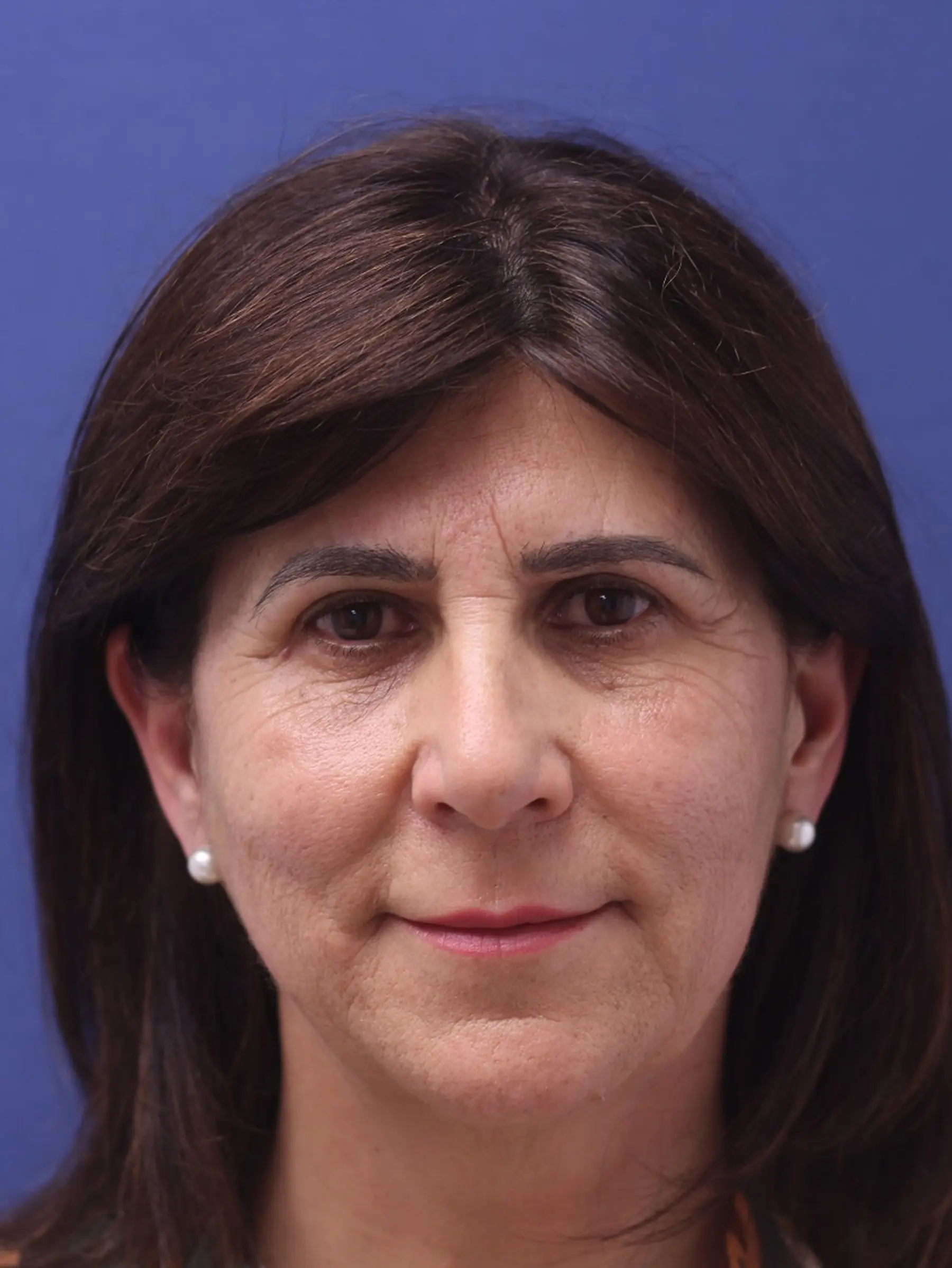 Paciente-Blefaroplastia-08