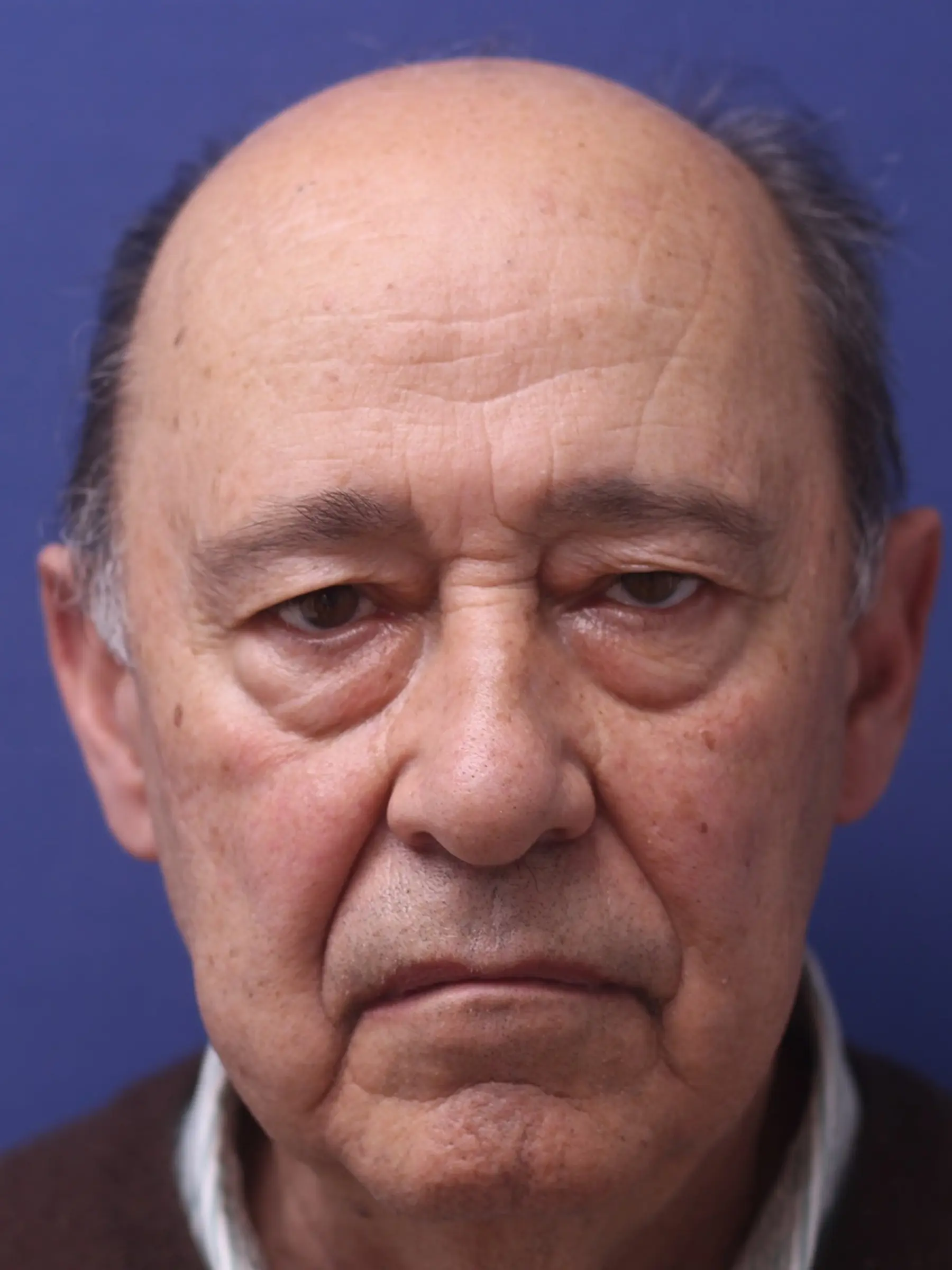 Paciente-Blefaroplastia-17