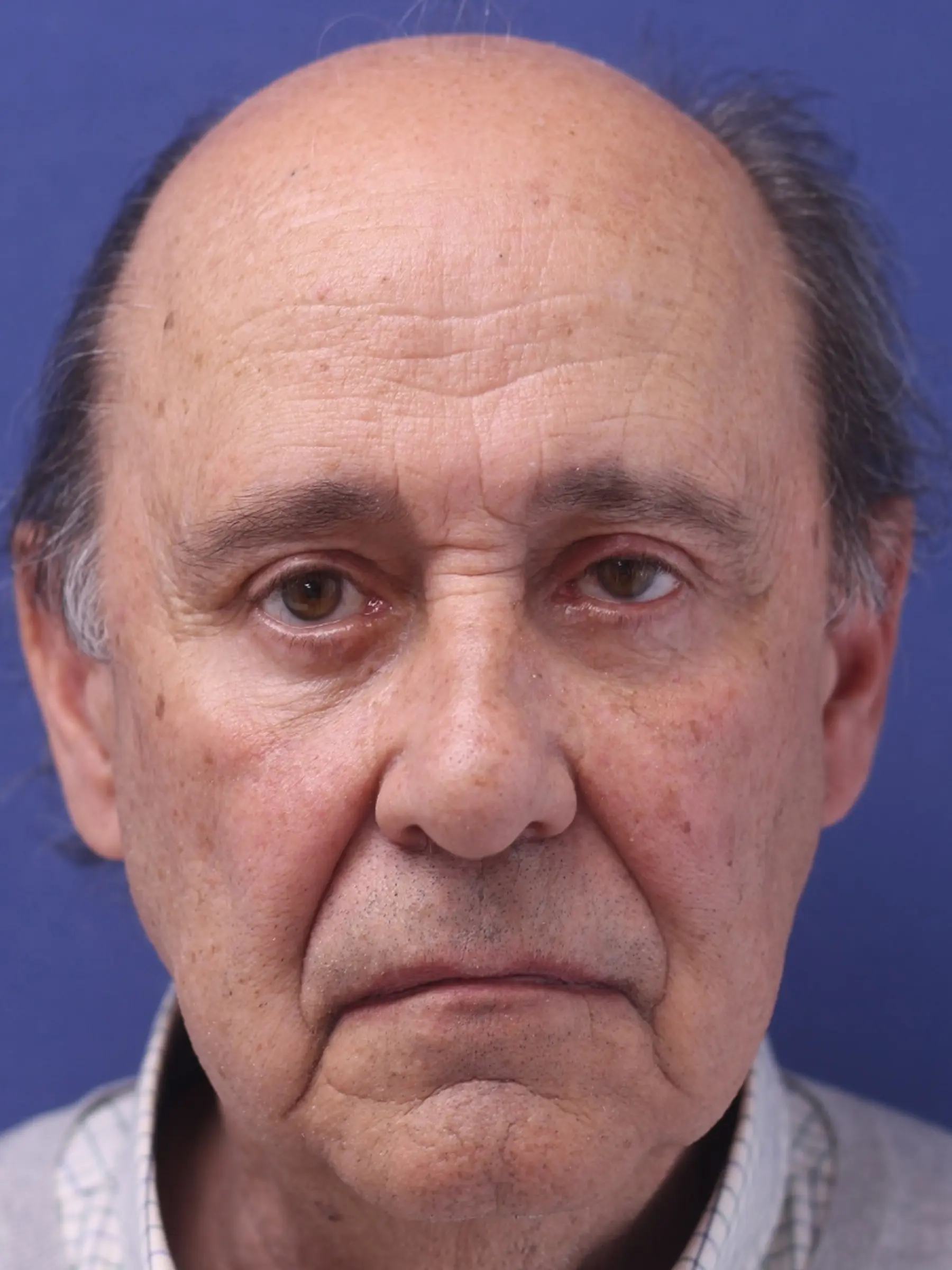 Paciente-Blefaroplastia-18