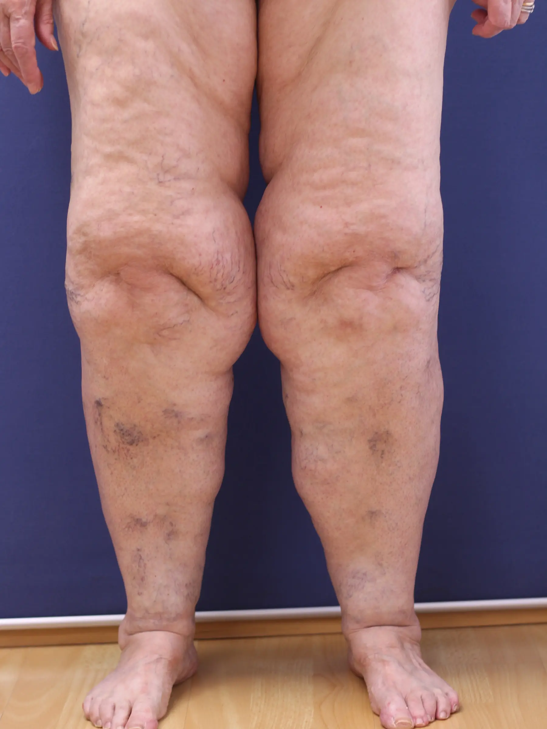 Paciente-Lipedema-01