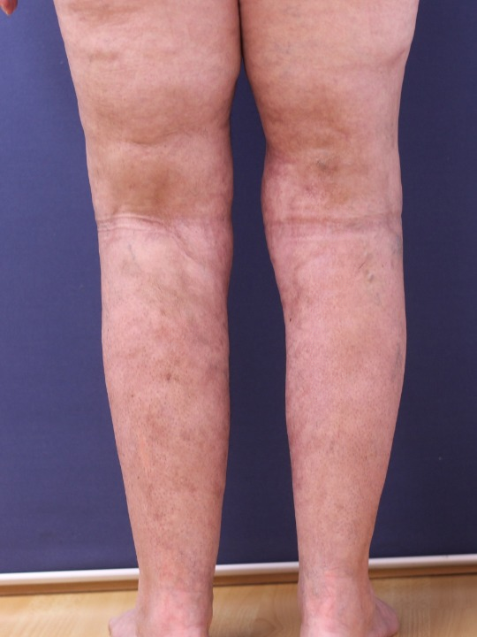 Paciente-Lipedema-010