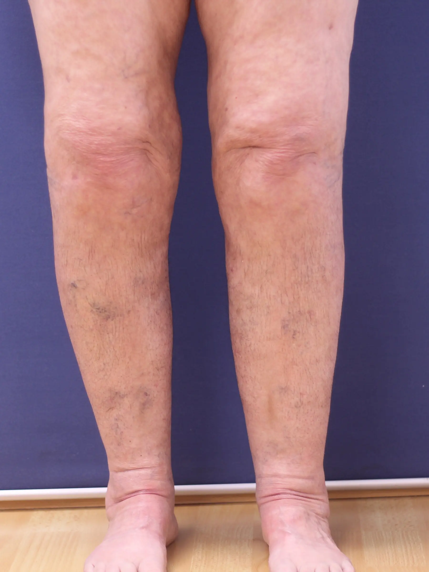 Paciente-Lipedema-02