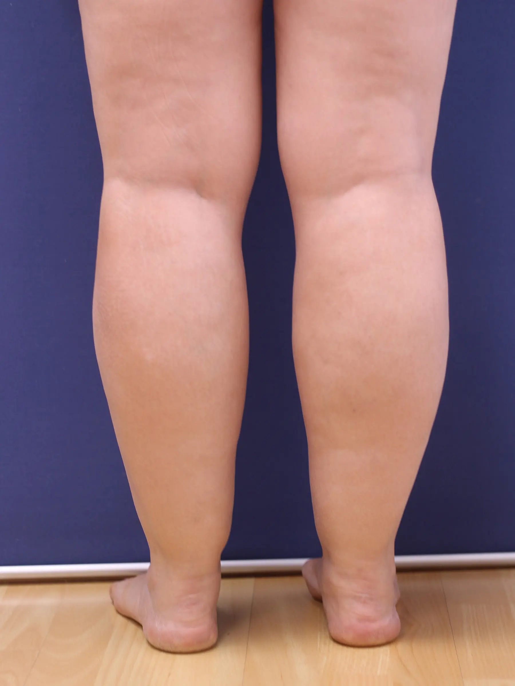 Paciente-Lipedema-03