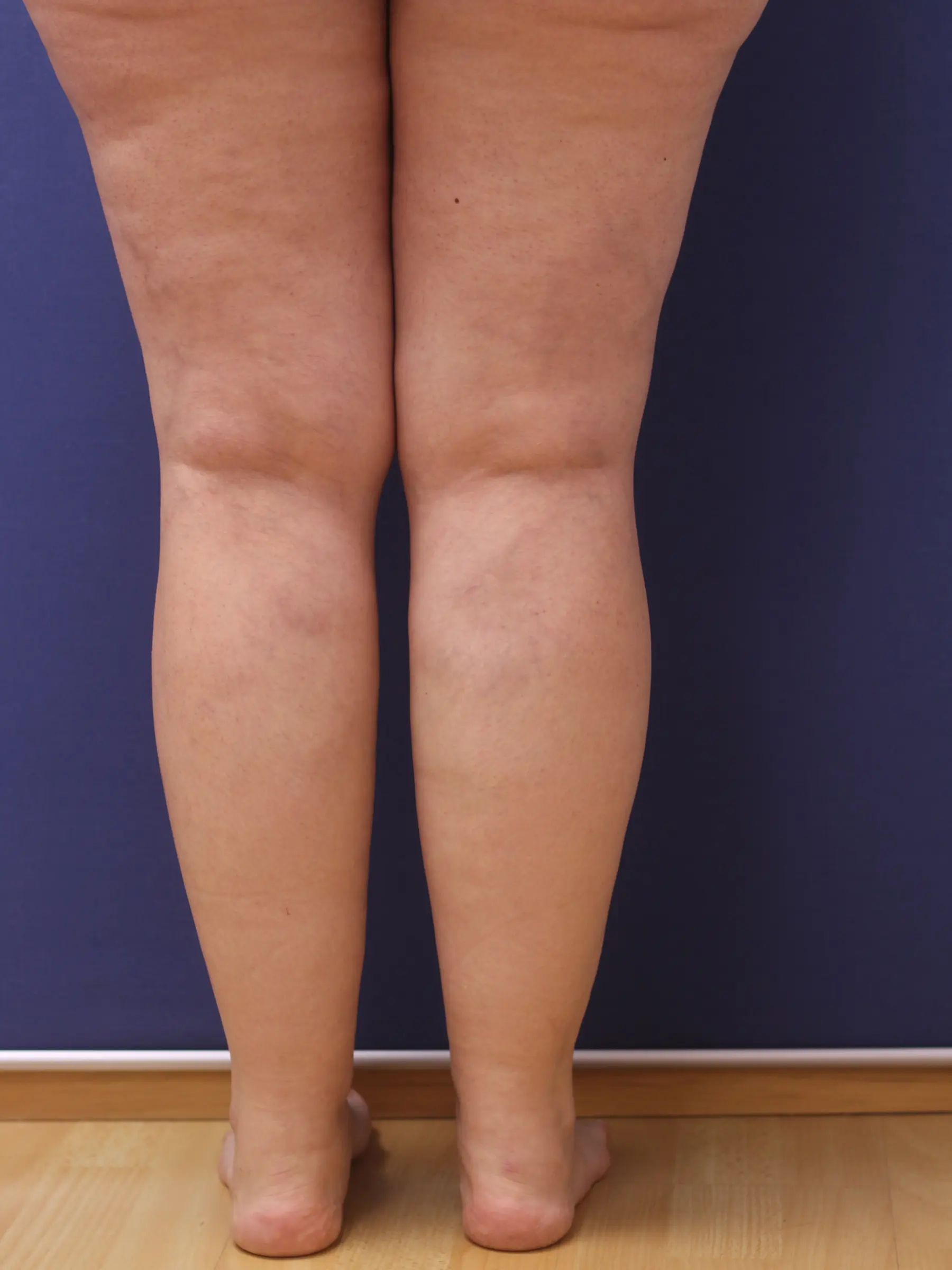 Paciente-Lipedema-04