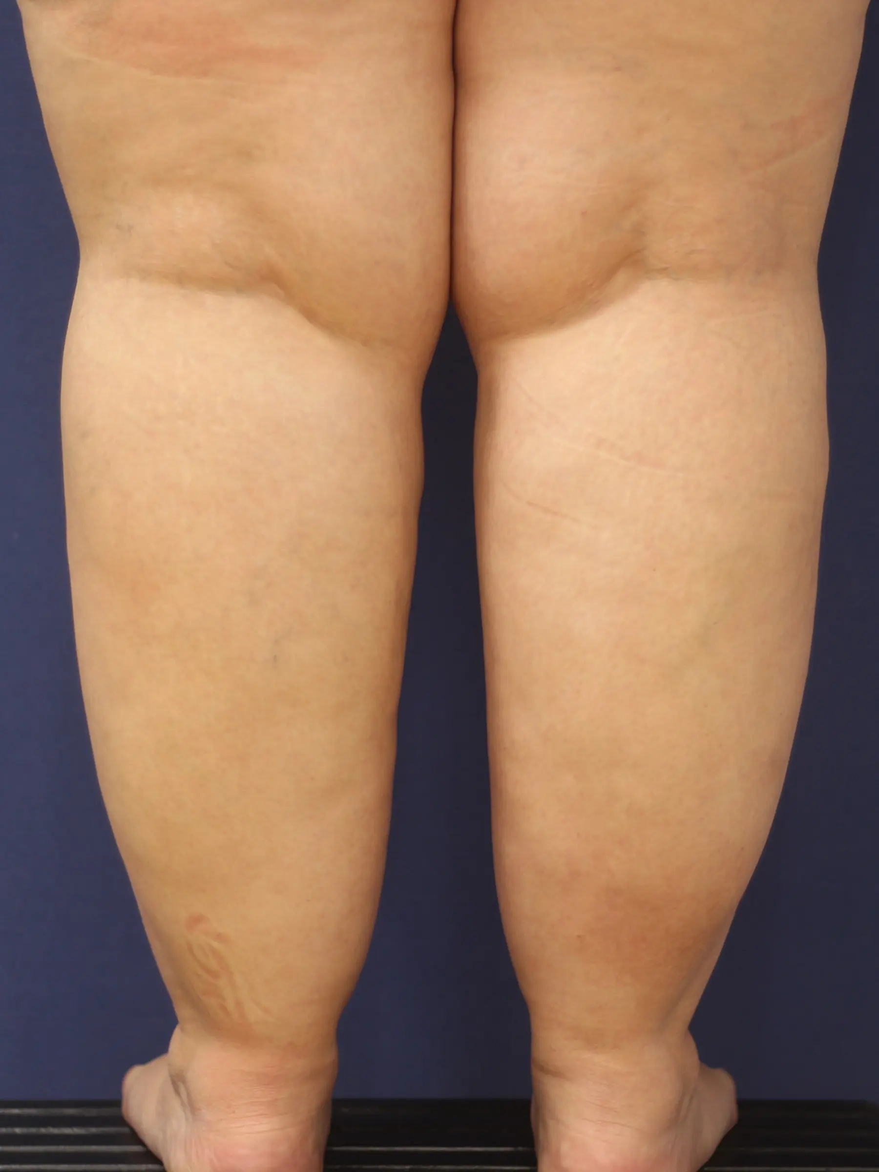 Paciente-Lipedema-05