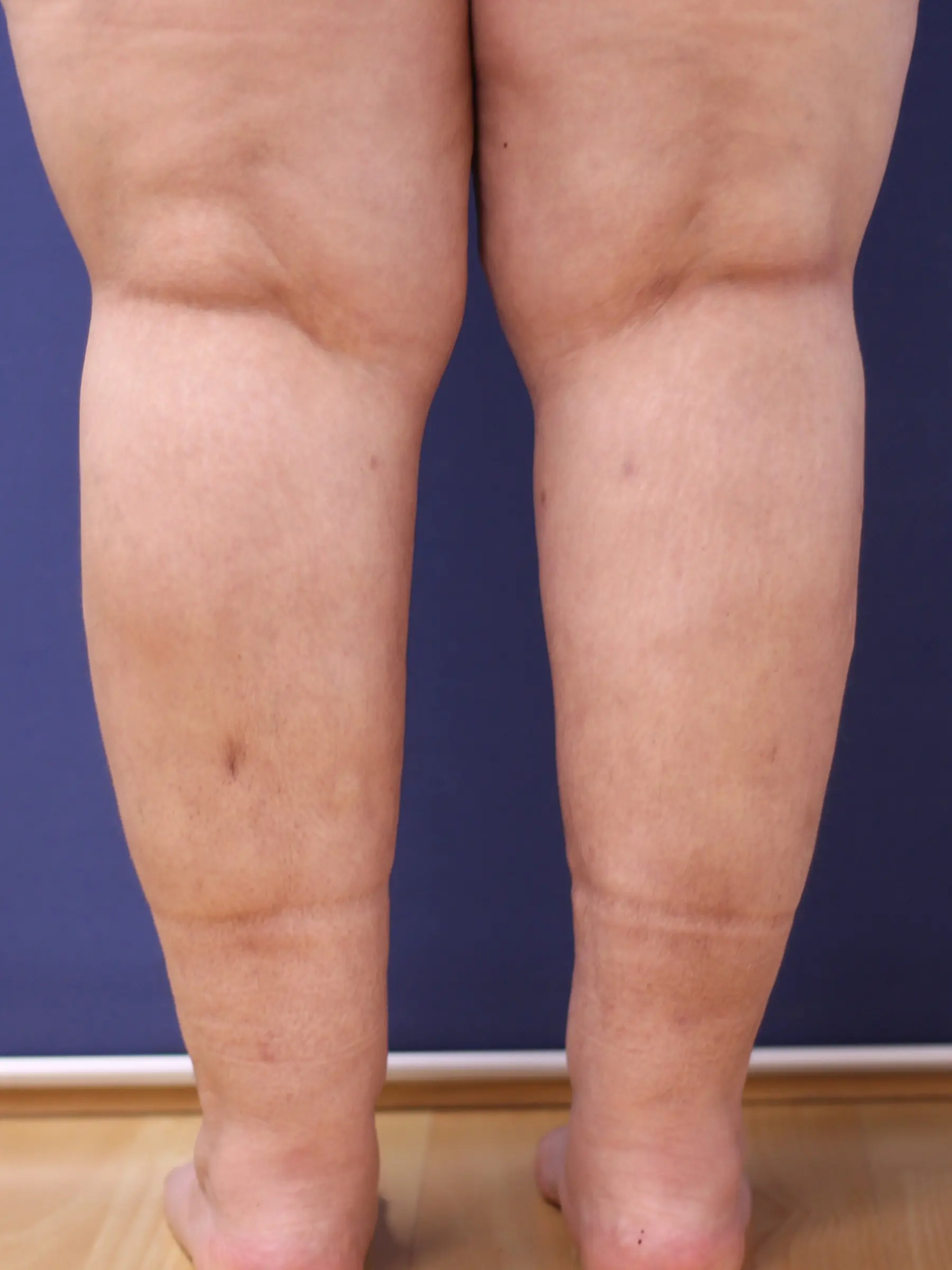 Paciente-Lipedema-06