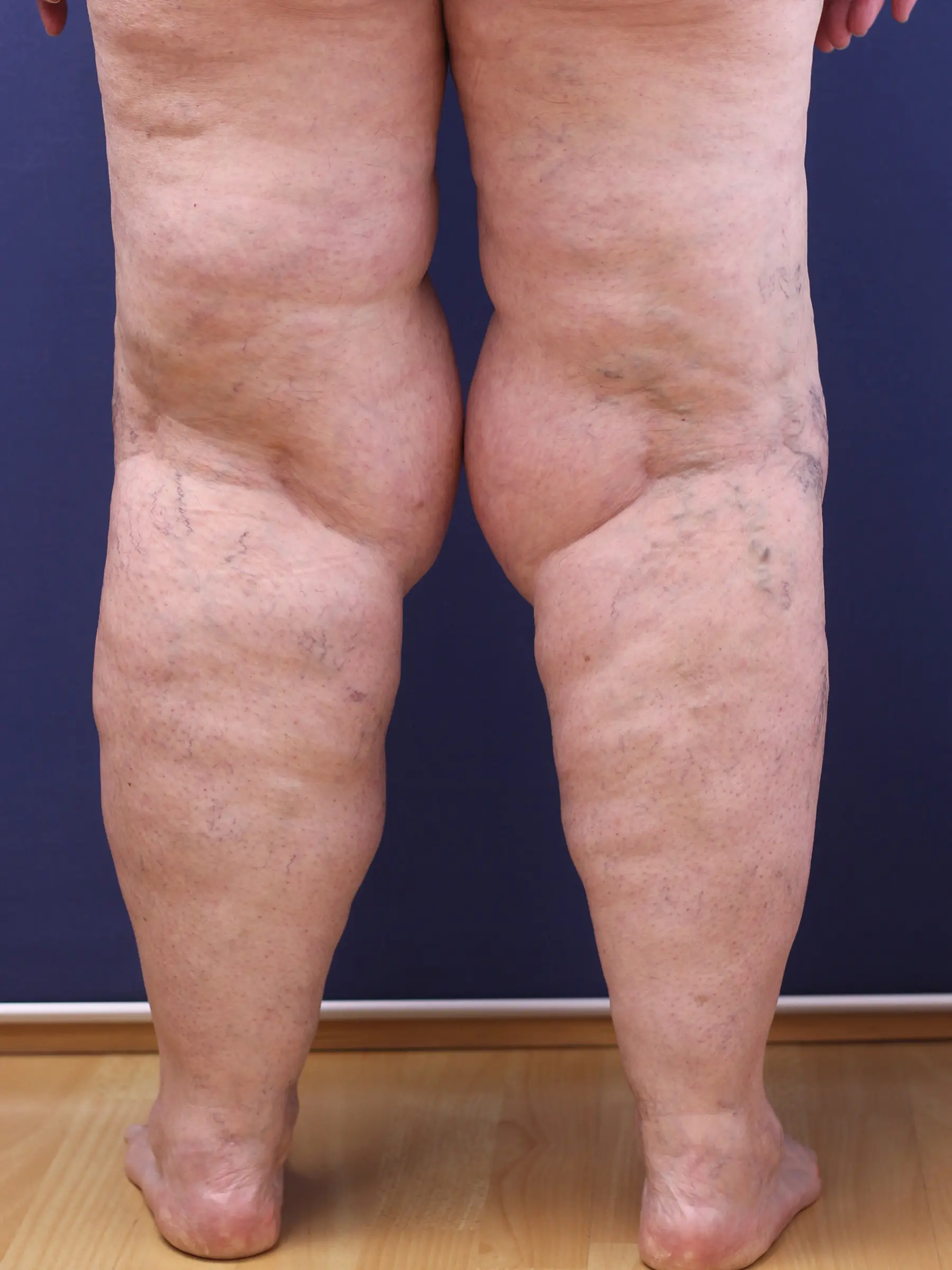 Paciente-Lipedema-09