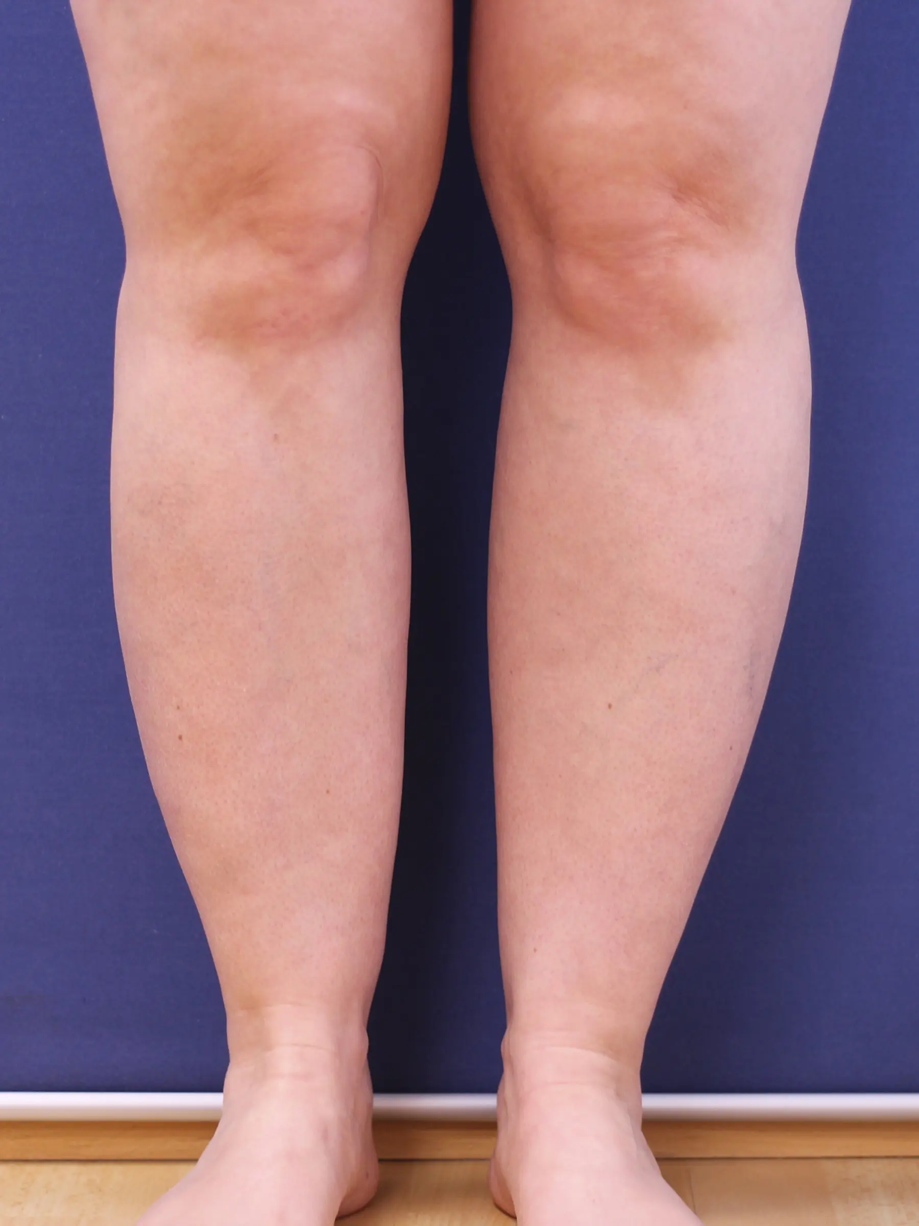 Paciente-Lipedema-11