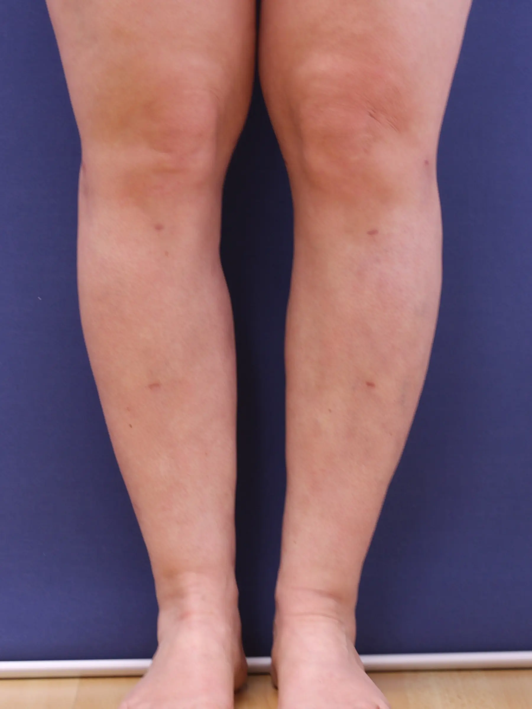 Paciente-Lipedema-12