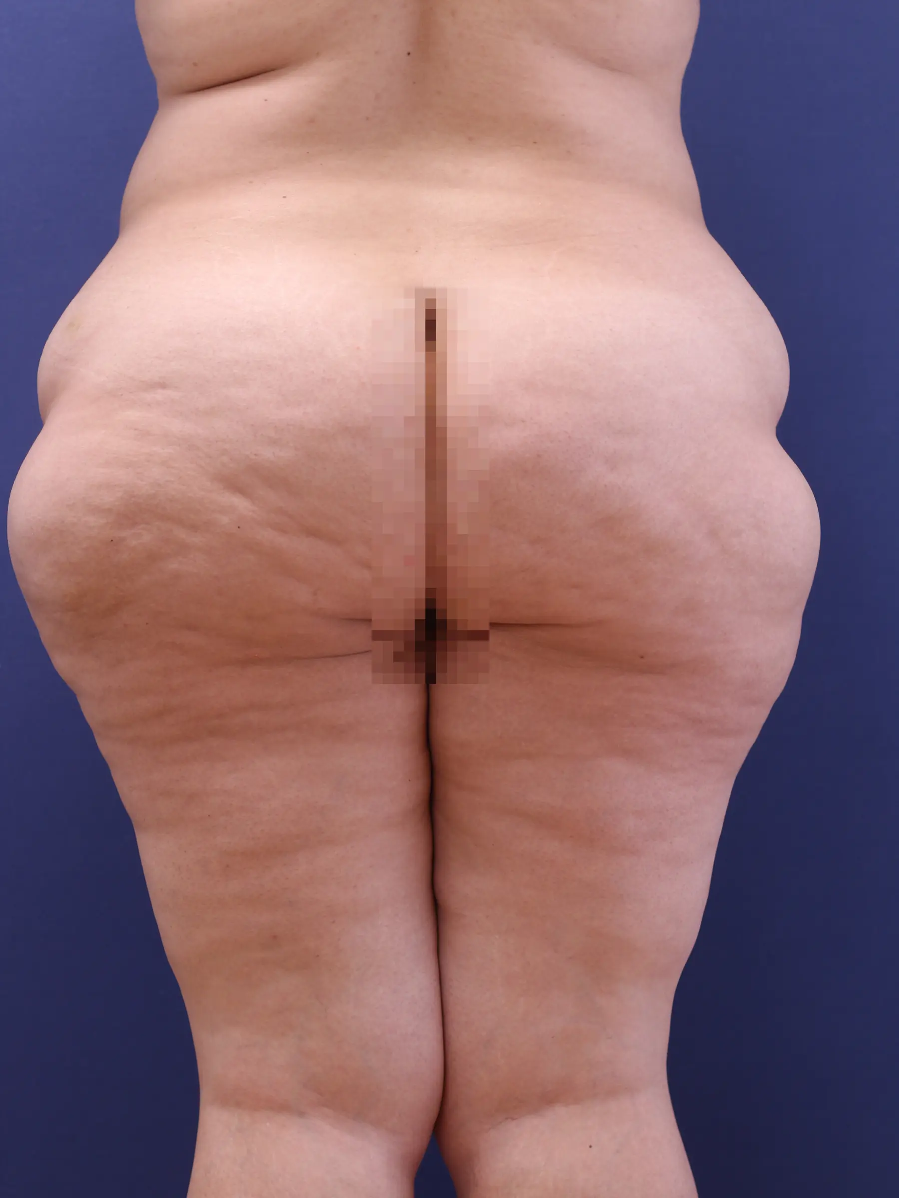 Paciente-Lipedema-17