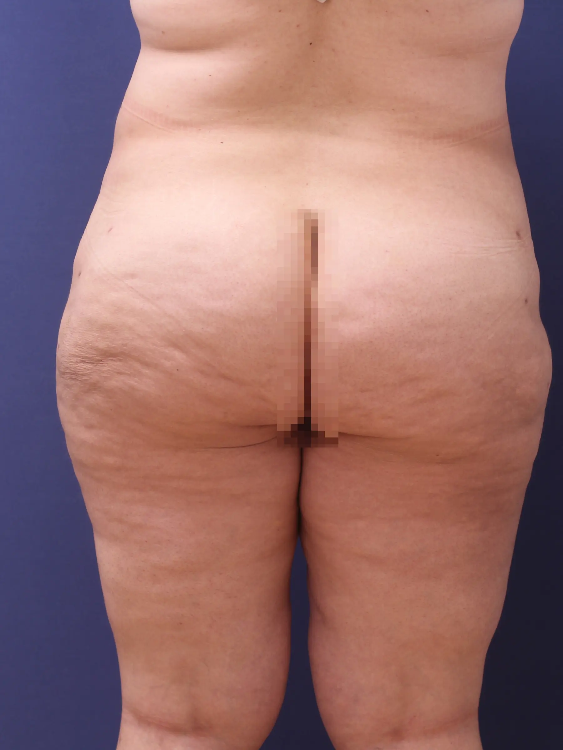 Paciente-Lipedema-18