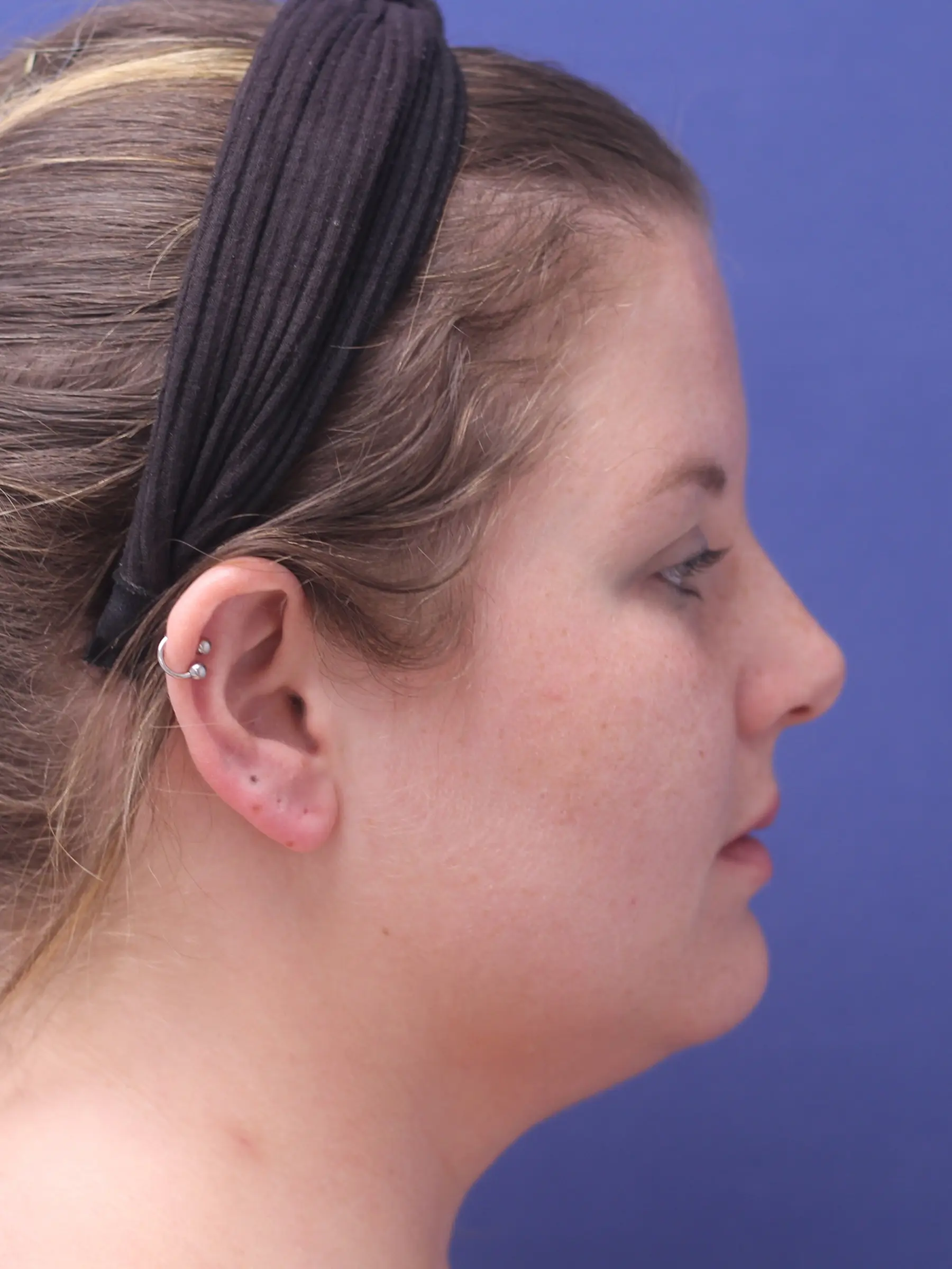 Paciente-Lipopapada-01