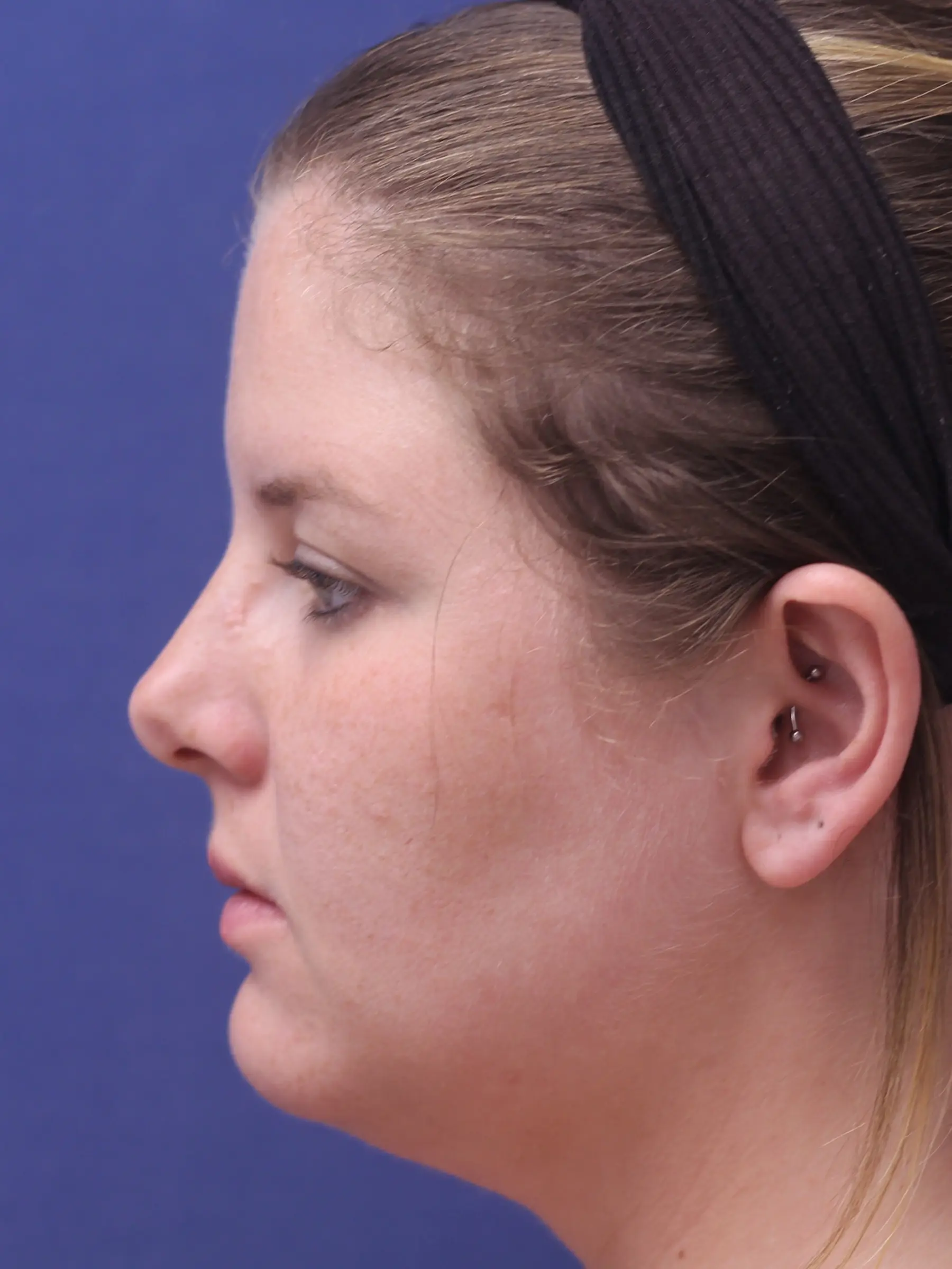 Paciente-Lipopapada-03