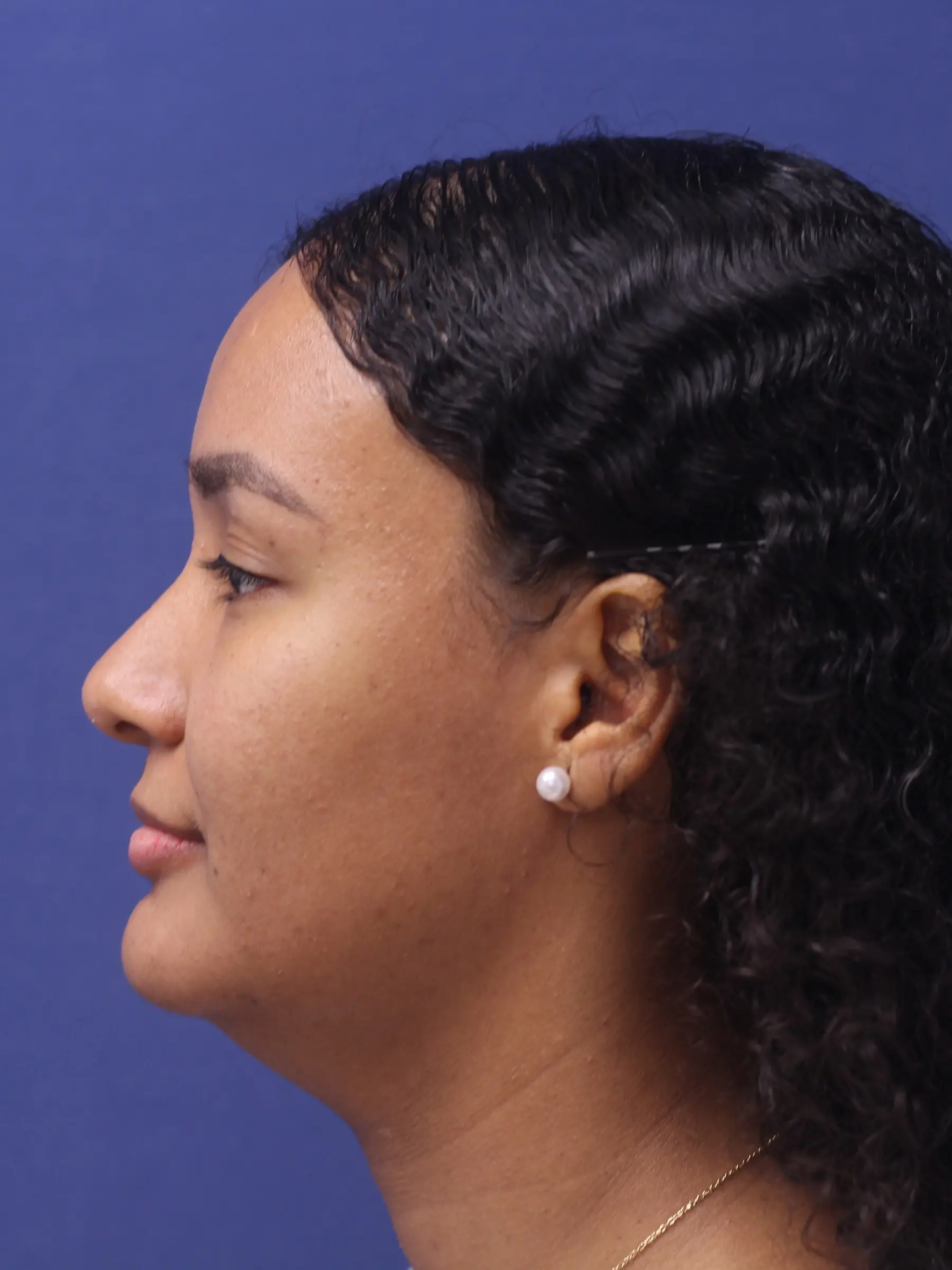 Paciente-Lipopapada-05