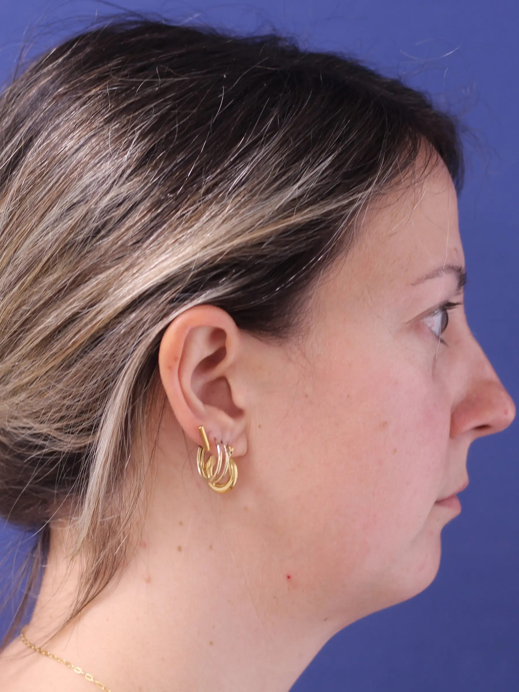 Paciente-Lipopapada-09