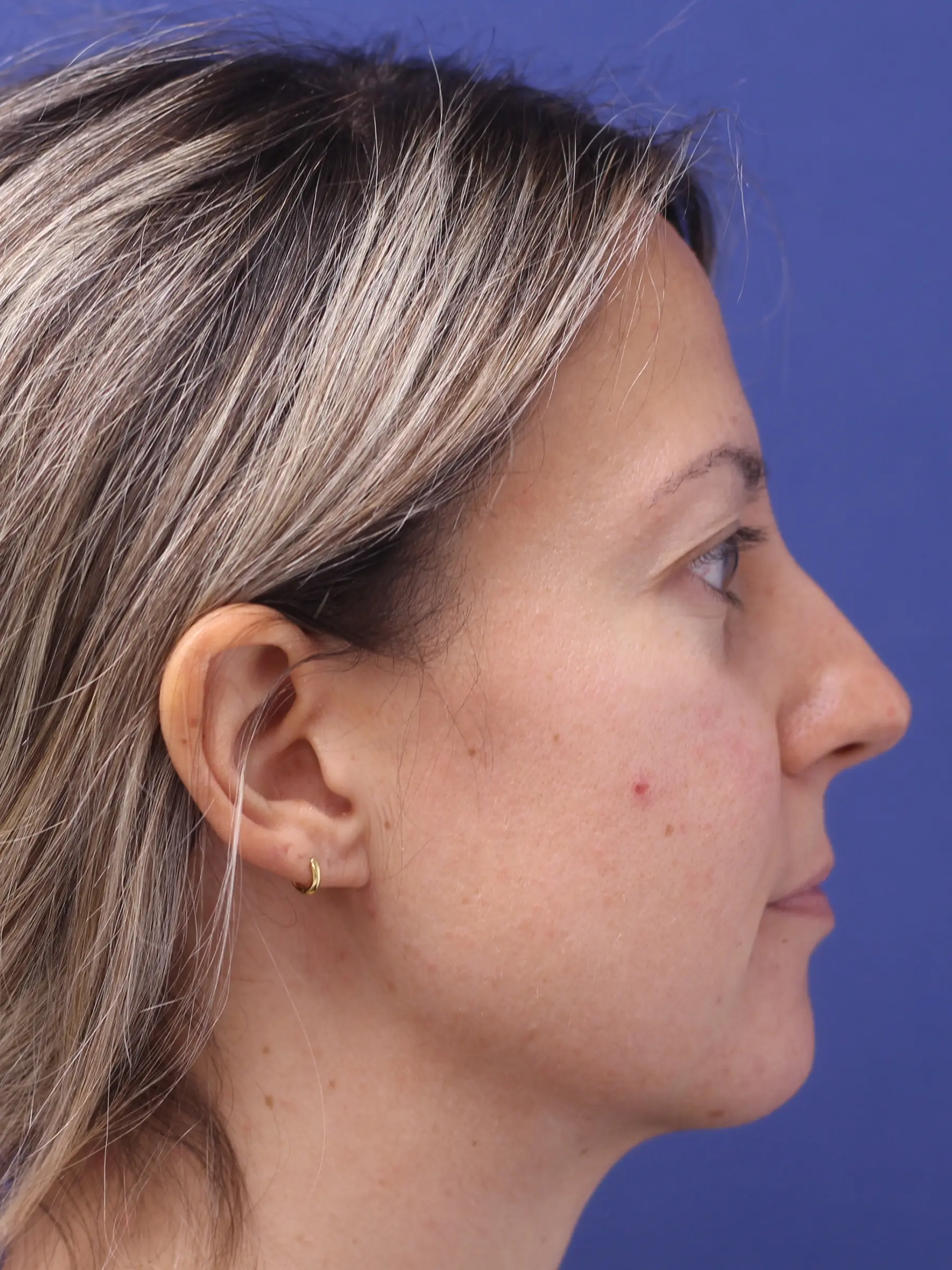 Paciente-Lipopapada-10