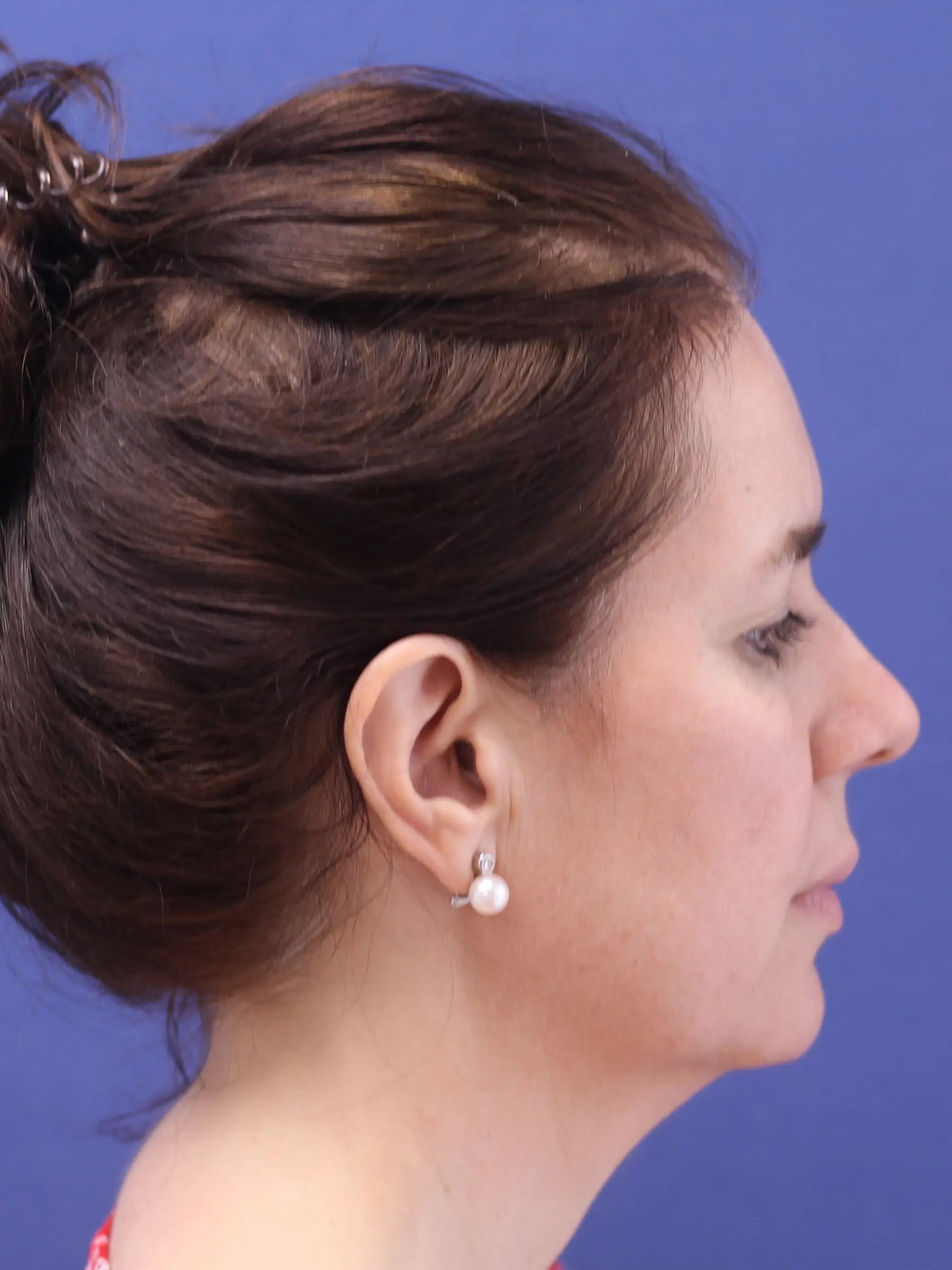 Paciente-Lipopapada-13