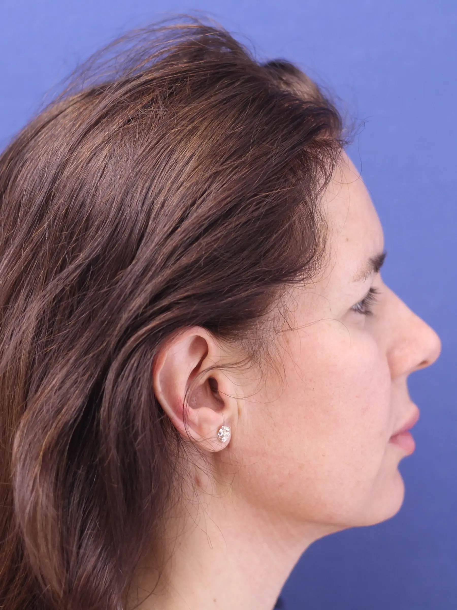 Paciente-Lipopapada-14