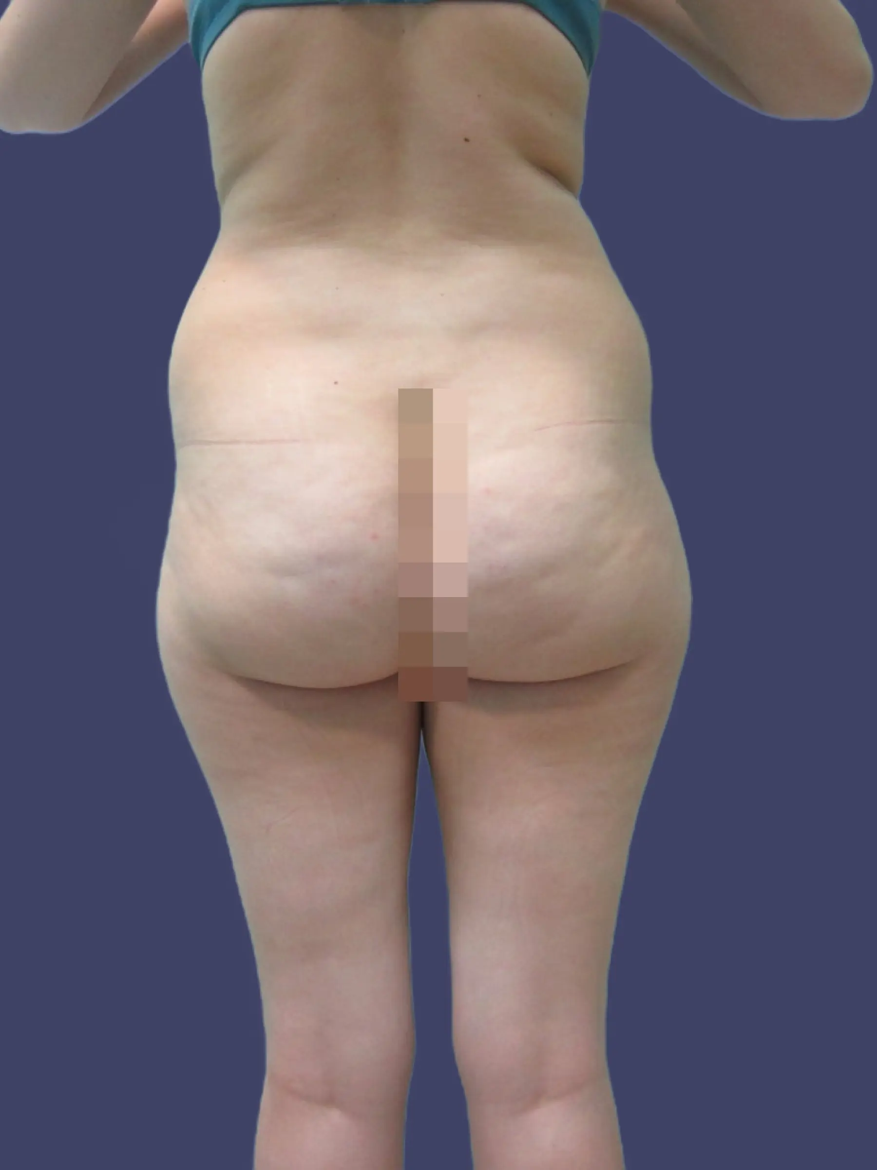 Paciente-Liposuccion-0001