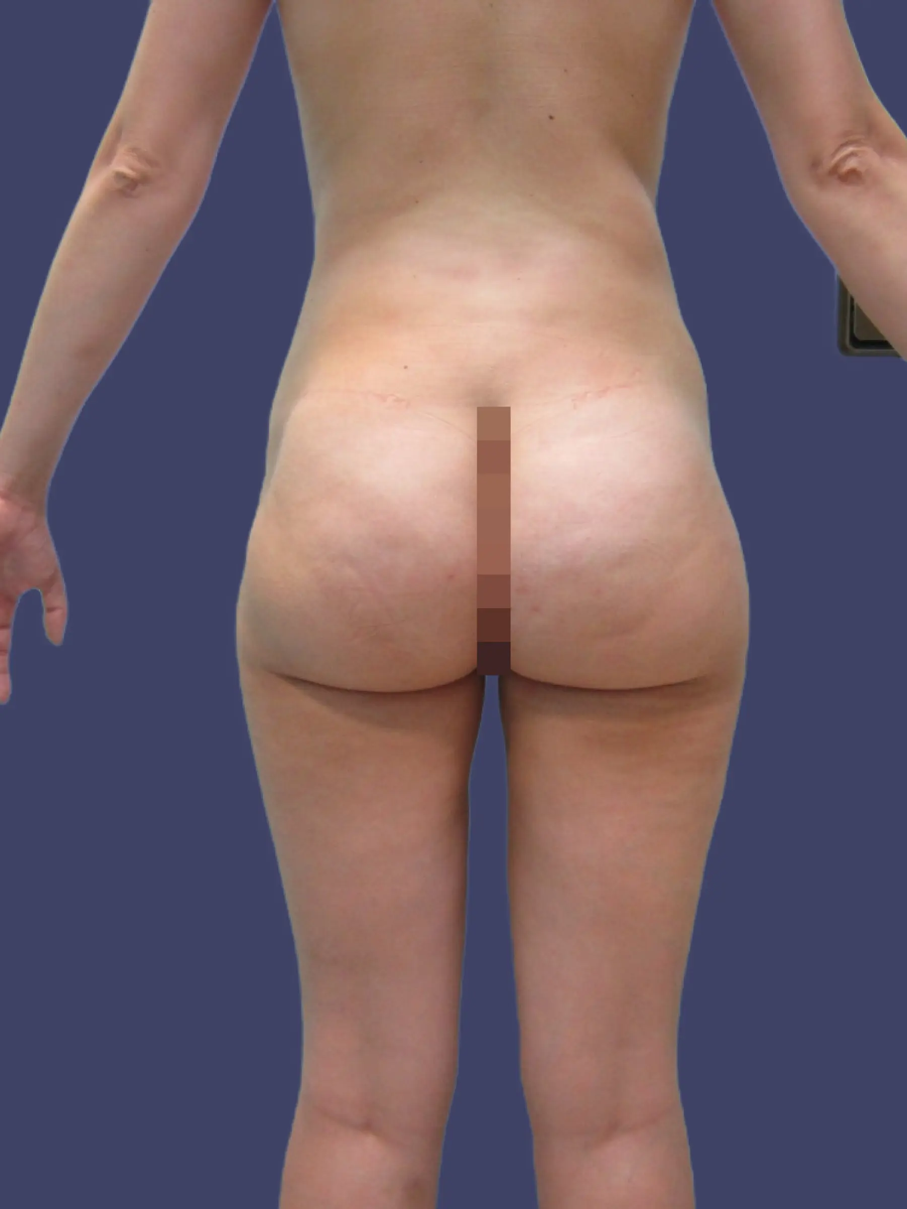 Paciente-Liposuccion-002