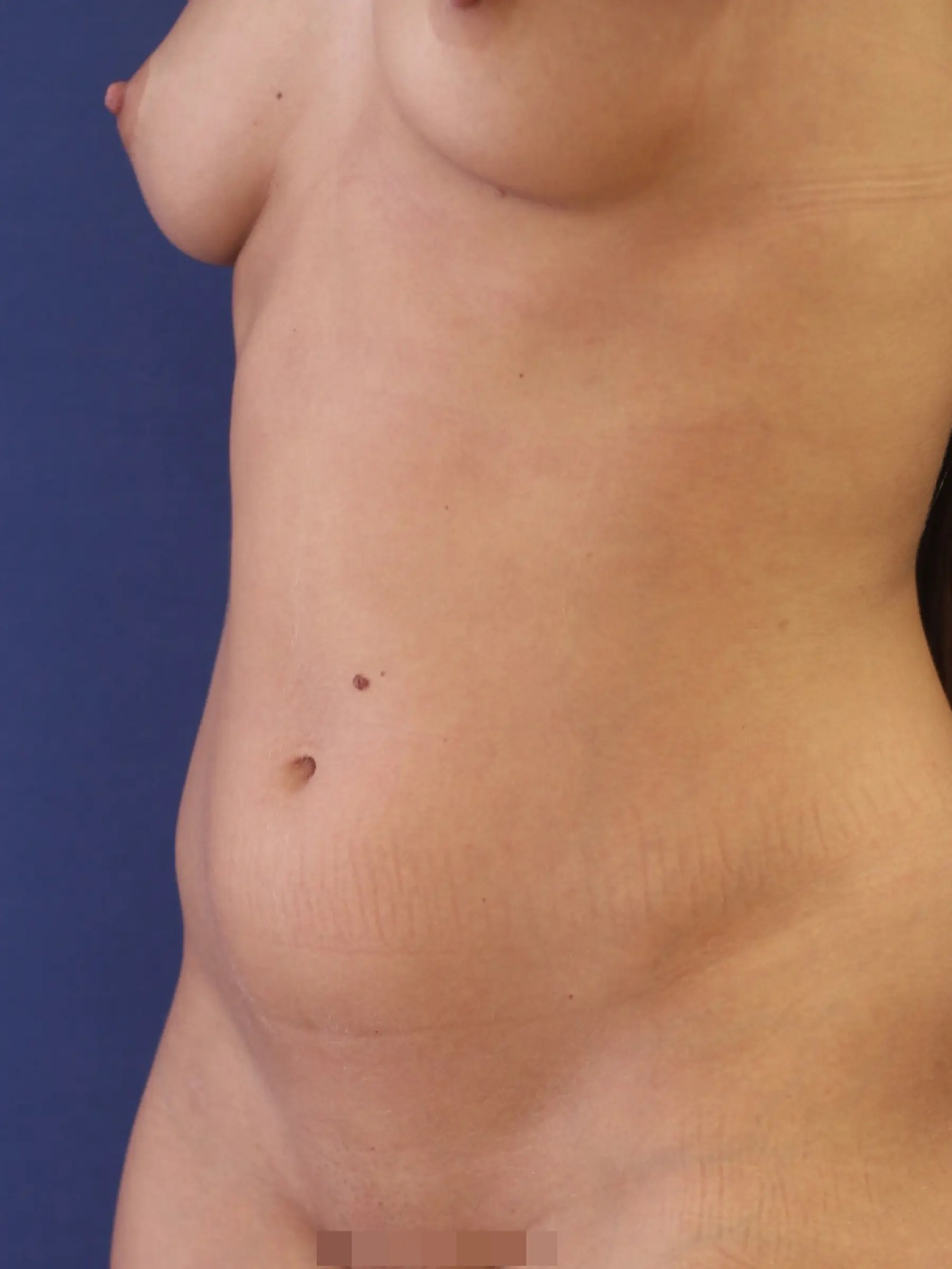 Paciente-Liposuccion-03