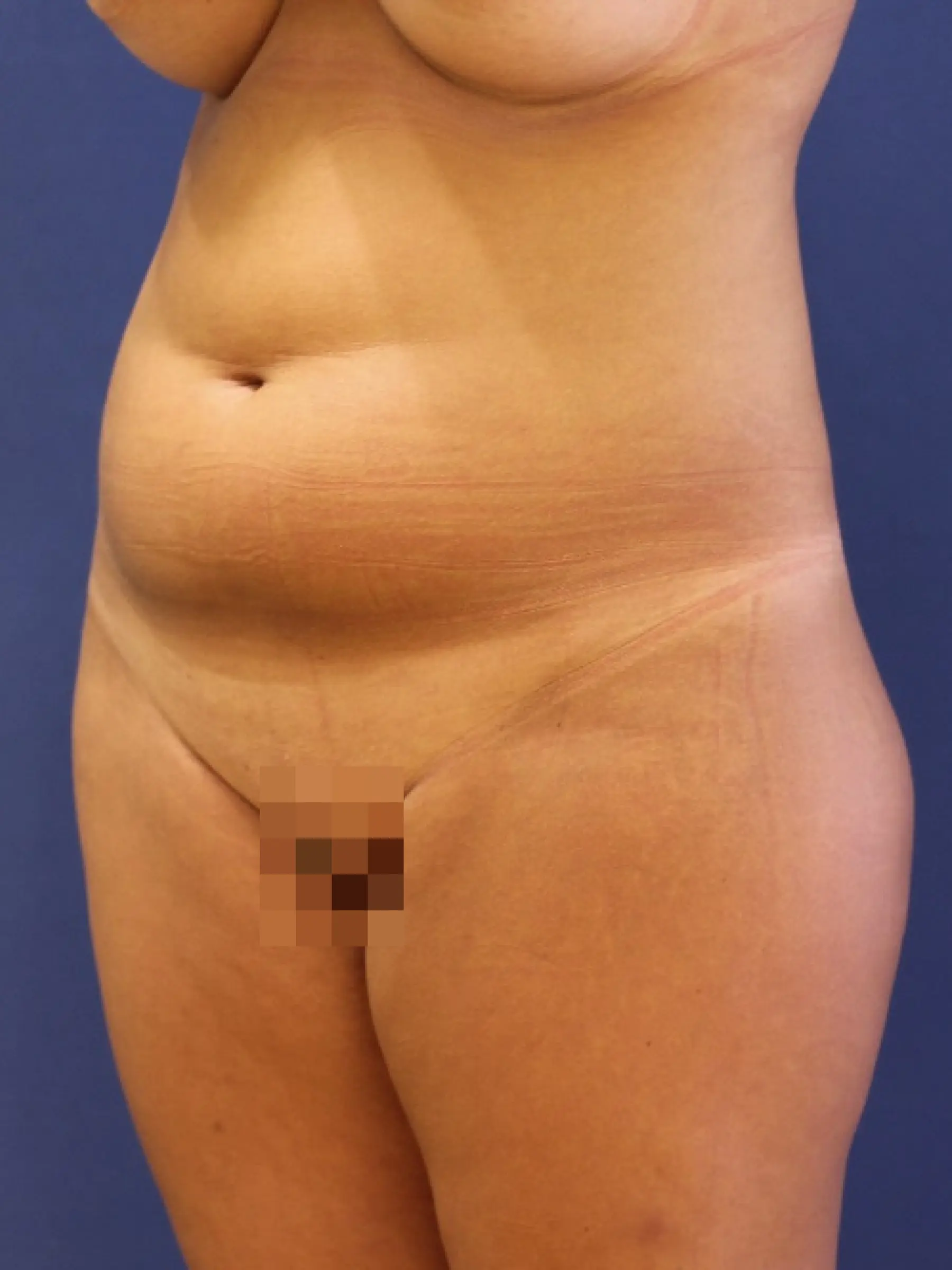 Paciente-Liposuccion-05