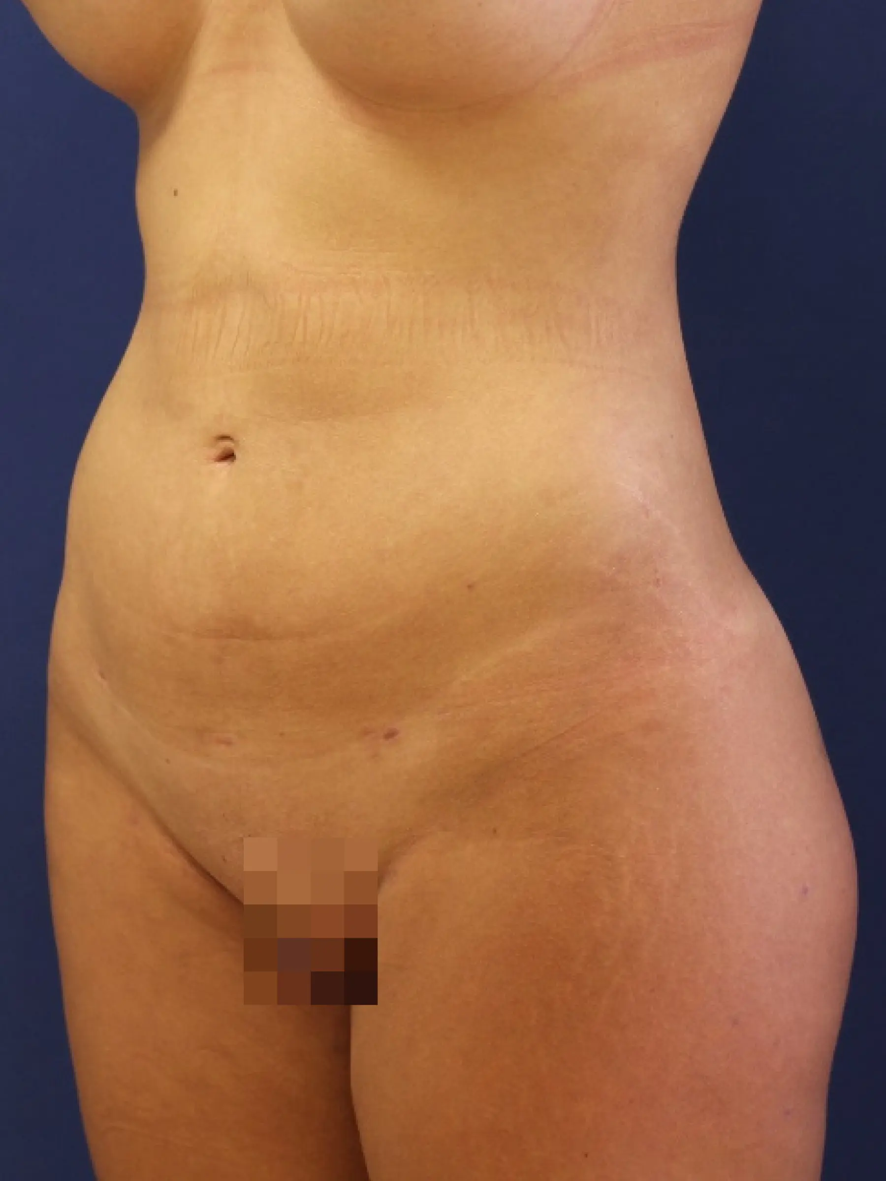 Paciente-Liposuccion-06