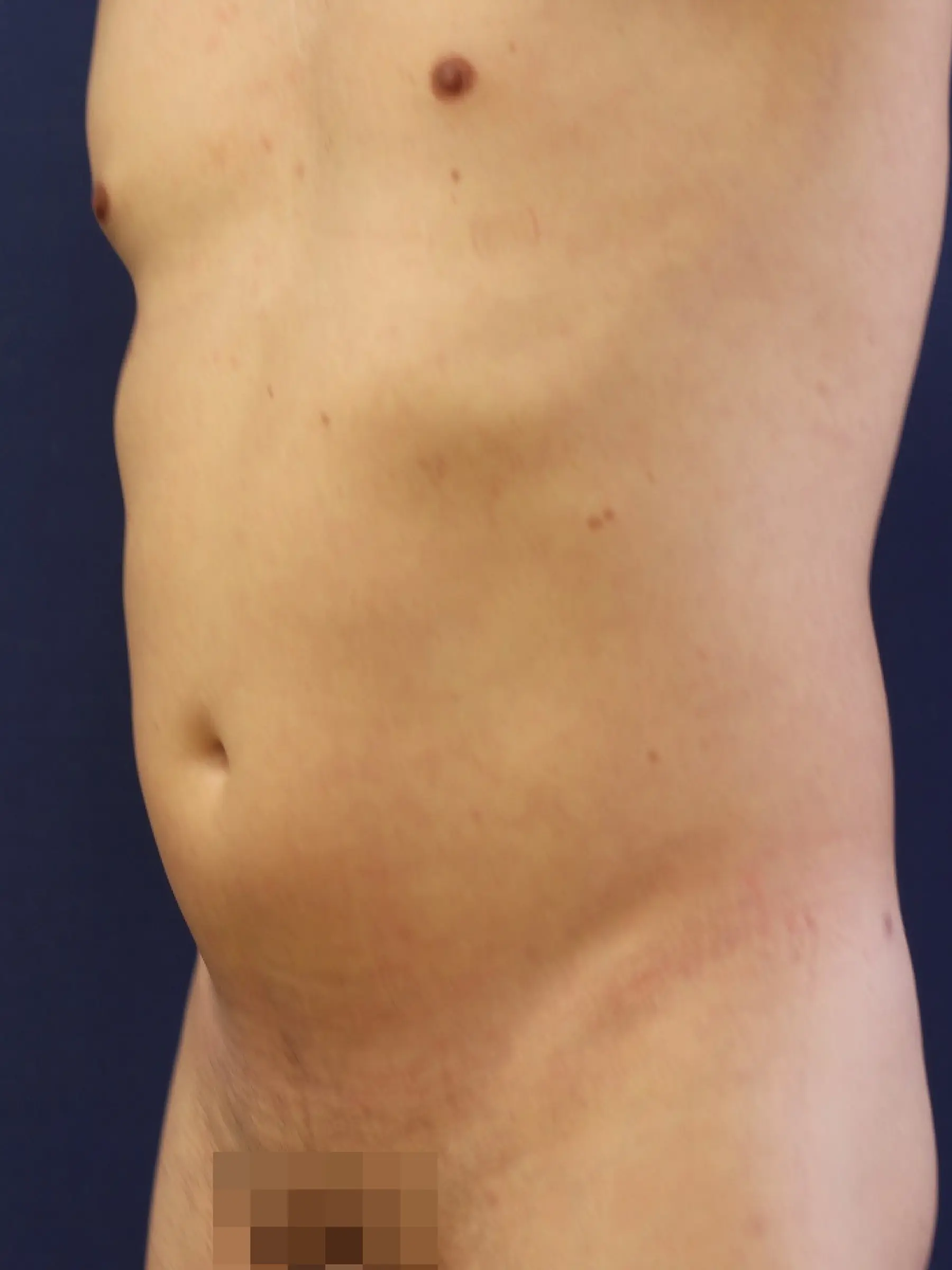 Paciente-Liposuccion-07
