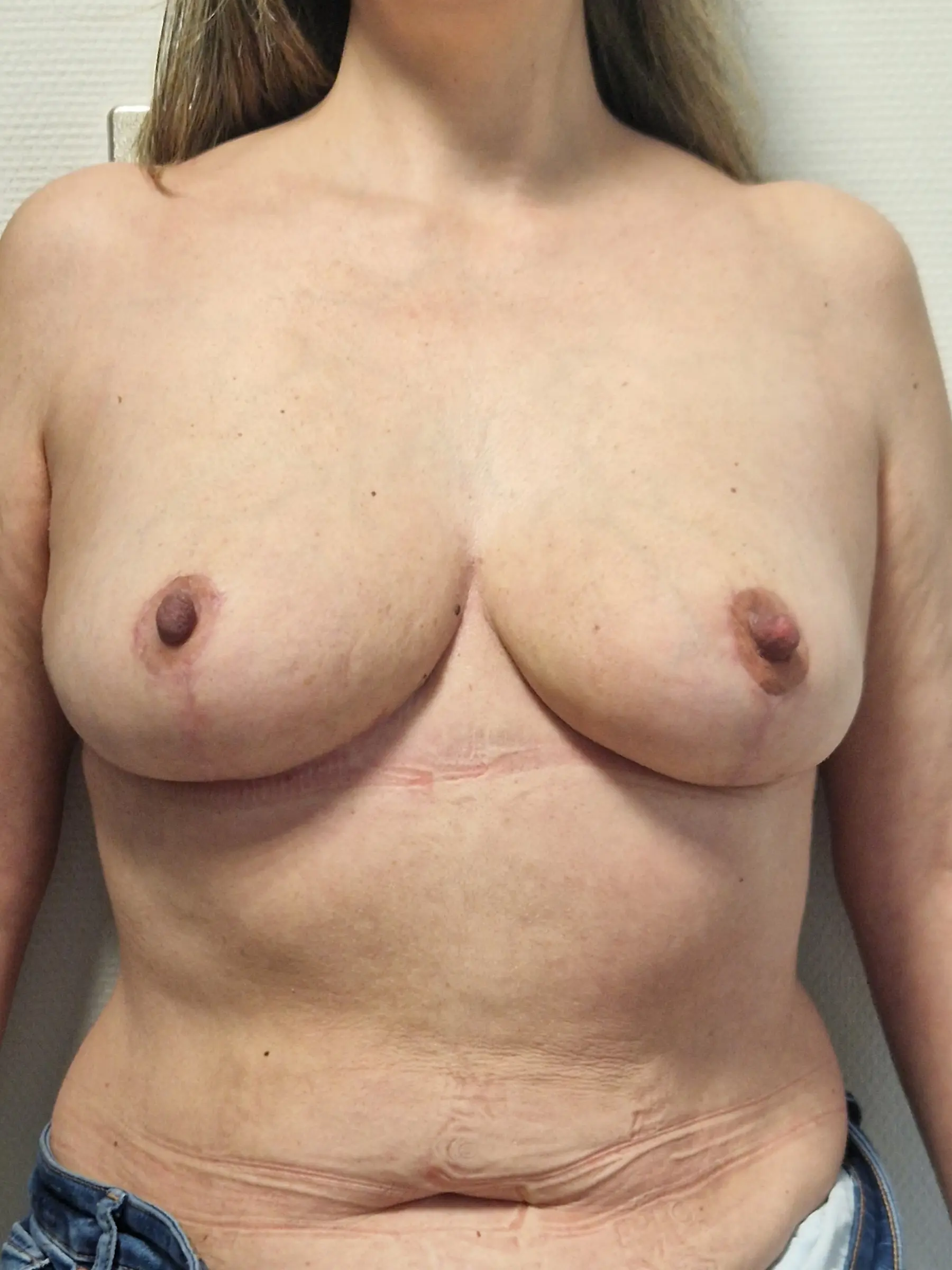 Paciente-Reduccion-Senos-18