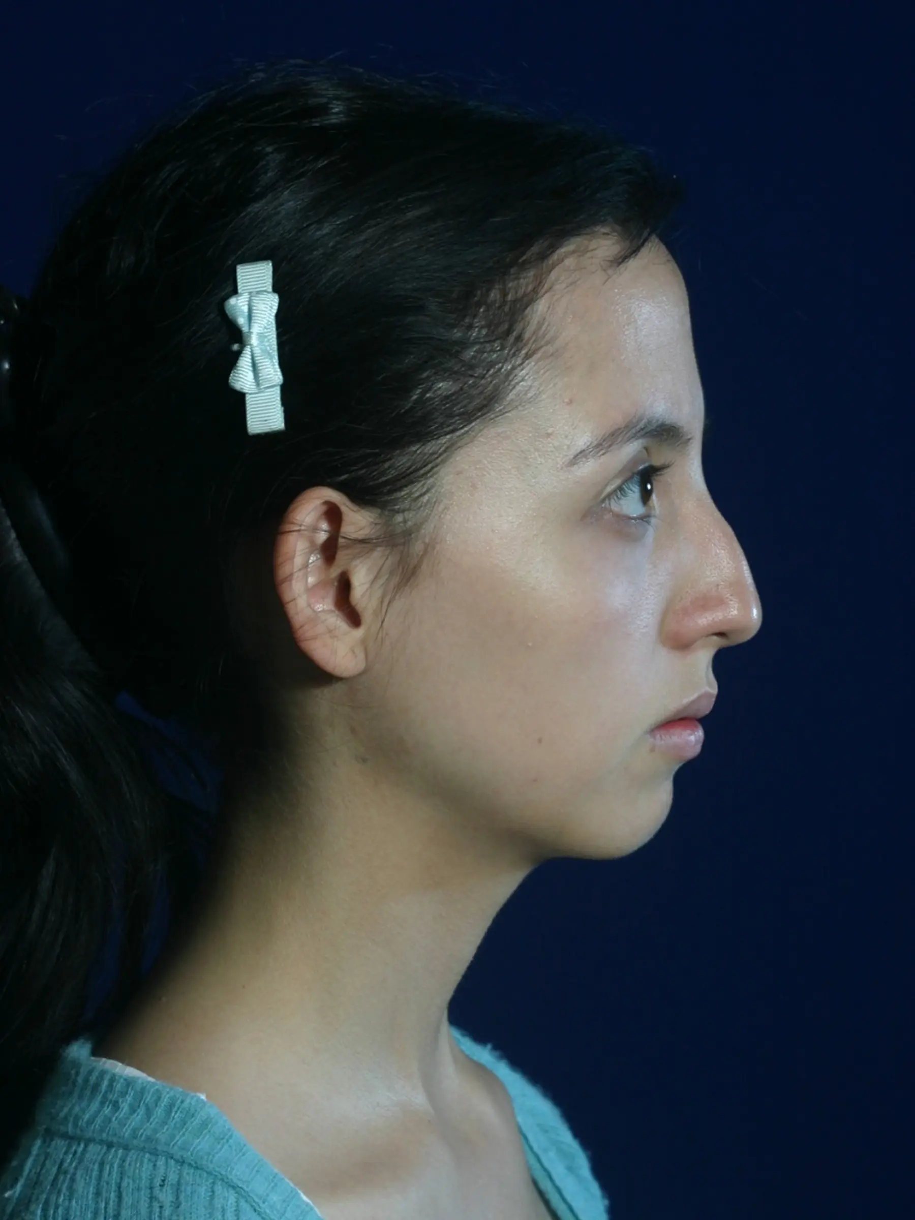 Paciente-Rinoplastia-01