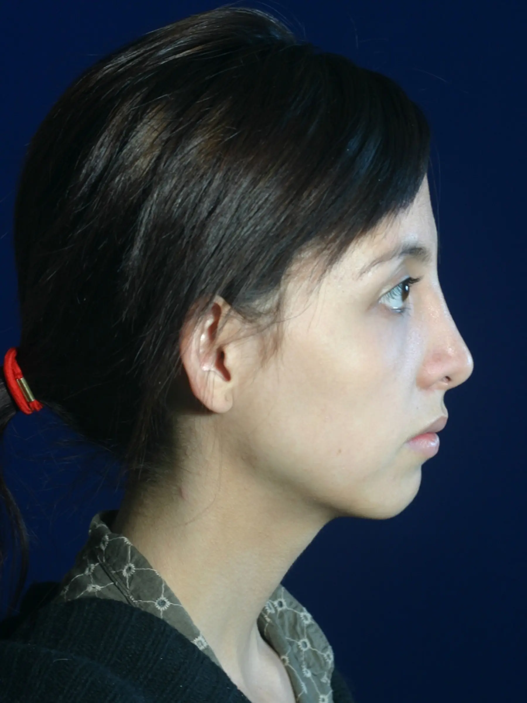 Paciente-Rinoplastia-02