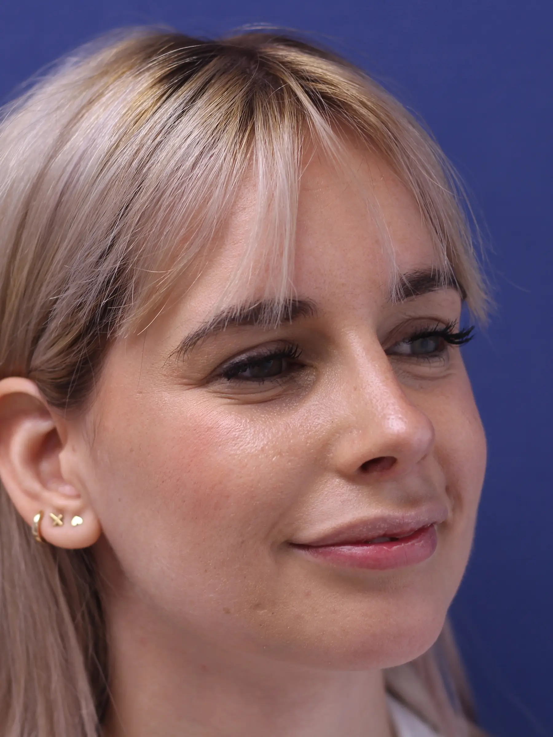 Paciente-Rinoplastia-04