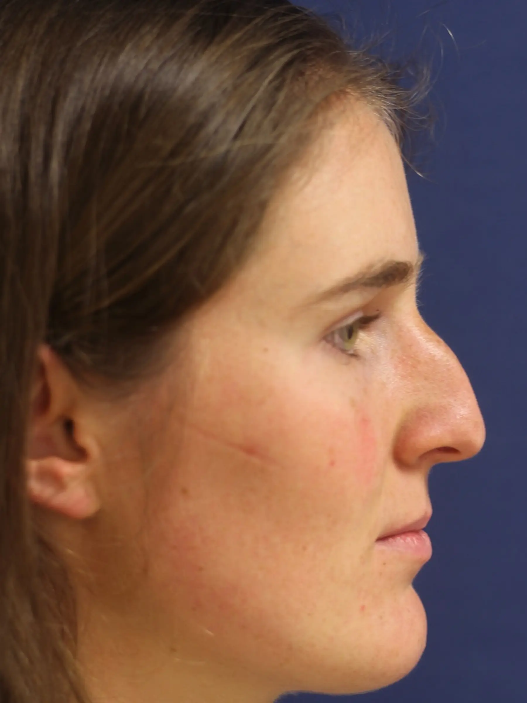 Paciente-Rinoplastia-05
