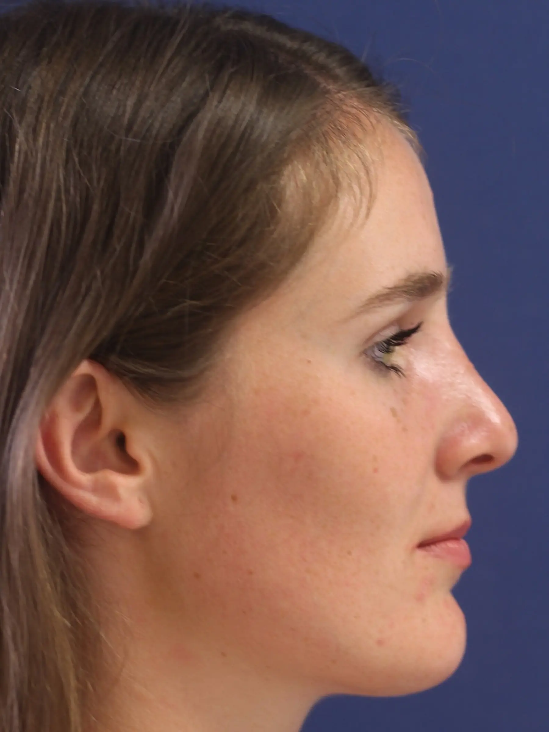 Paciente-Rinoplastia-06