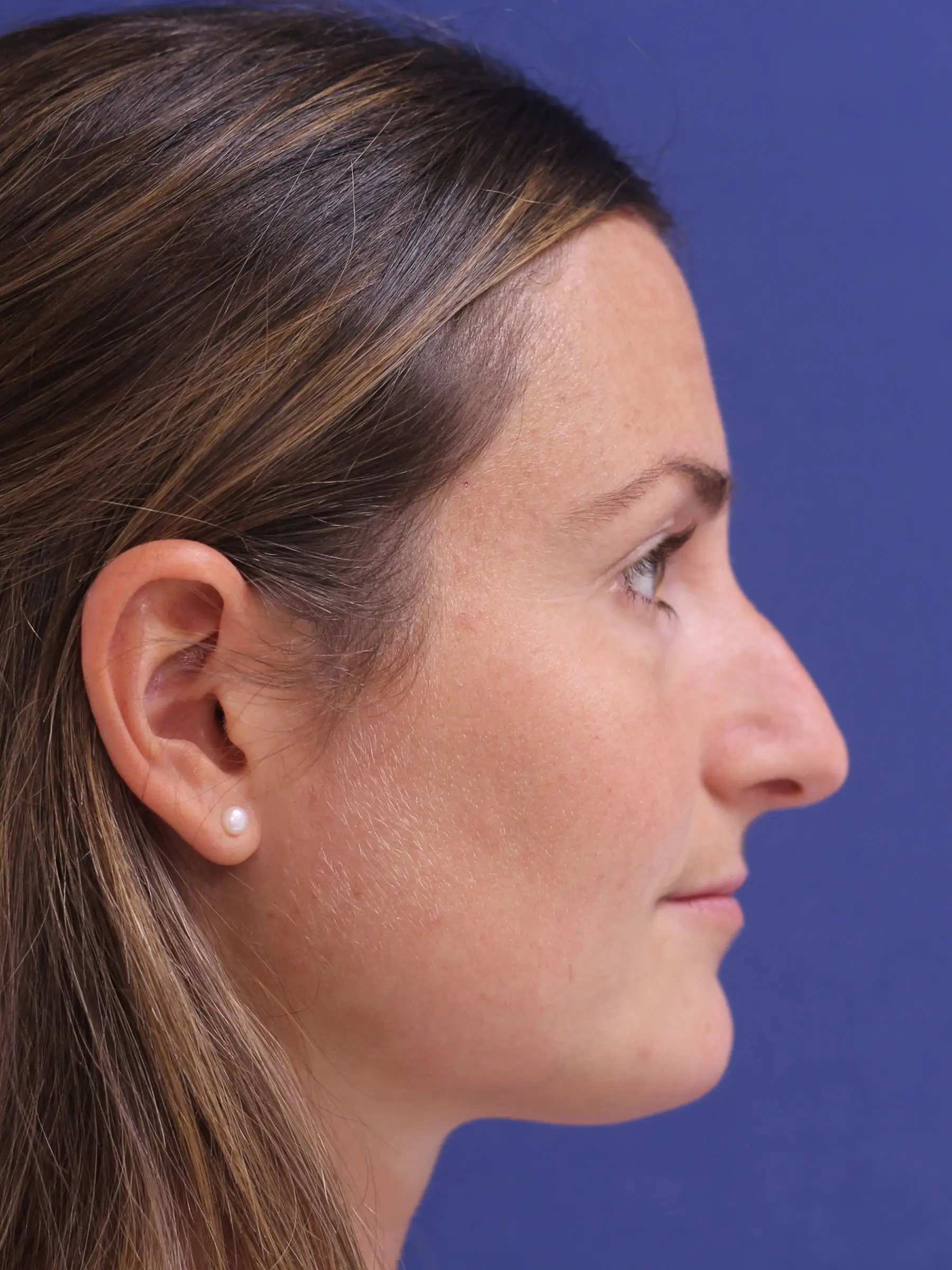 Paciente-Rinoplastia-07