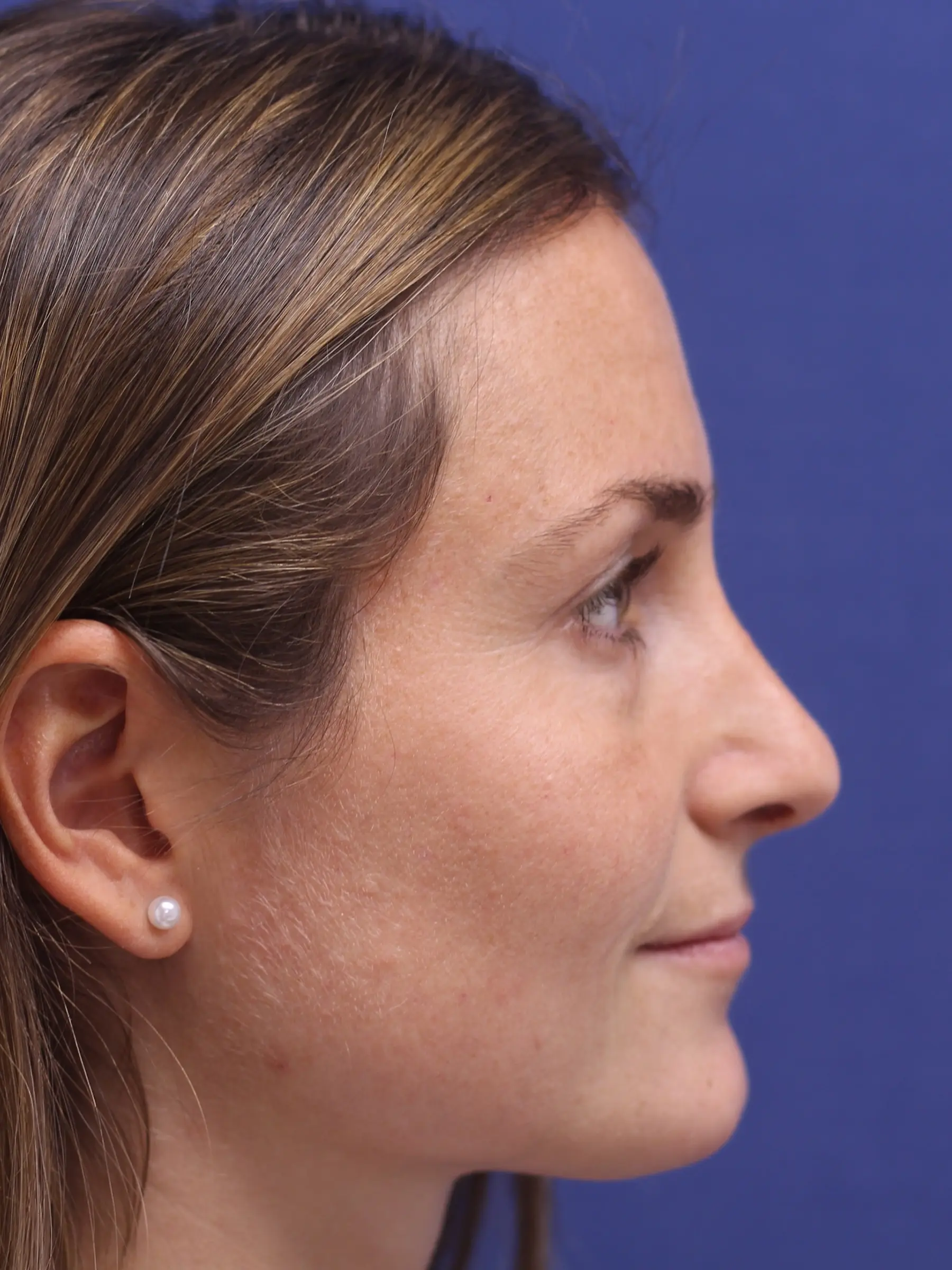 Paciente-Rinoplastia-08