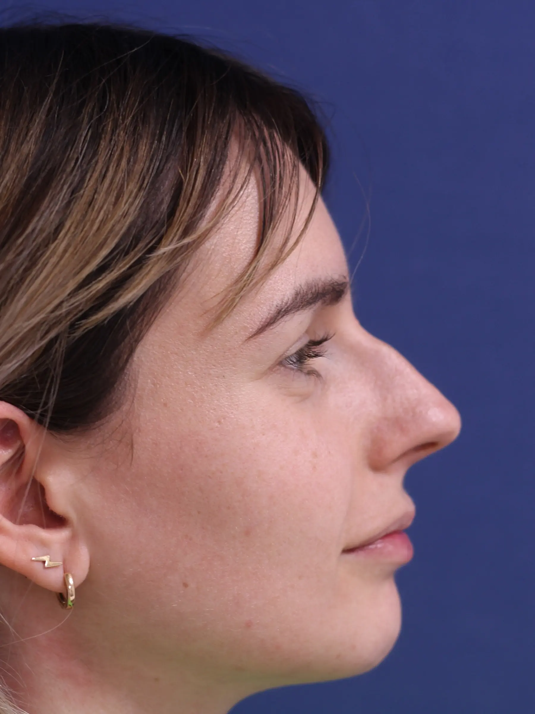 Paciente-Rinoplastia-09