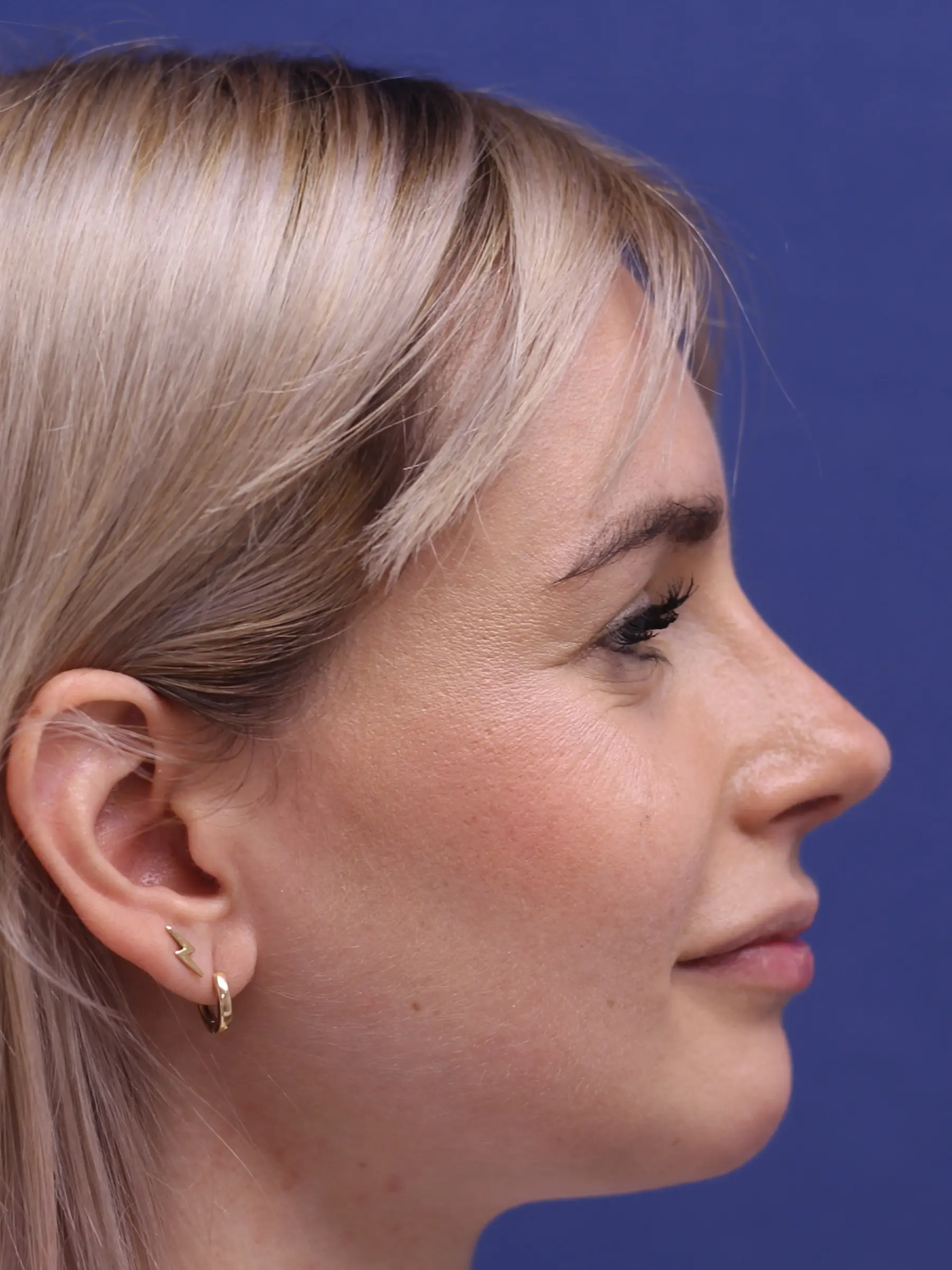 Paciente-Rinoplastia-10